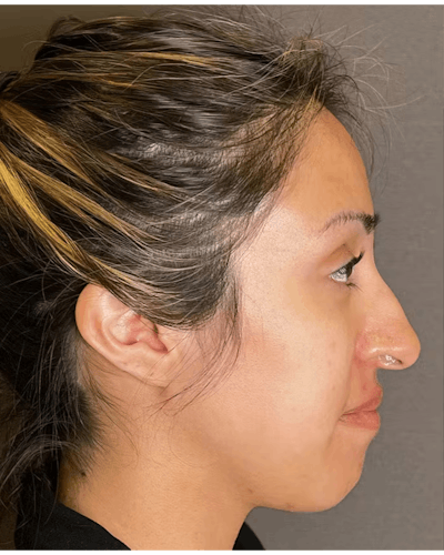 Rhinoplasty Before & After Gallery - Patient 900363 - Image 1