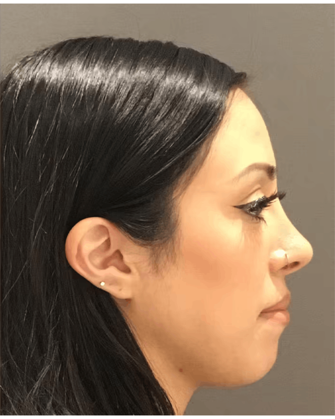 Rhinoplasty Before & After Gallery - Patient 900363 - Image 2