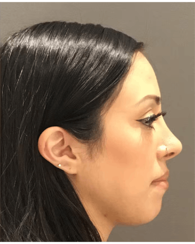 Rhinoplasty Before & After Gallery - Patient 900363 - Image 2