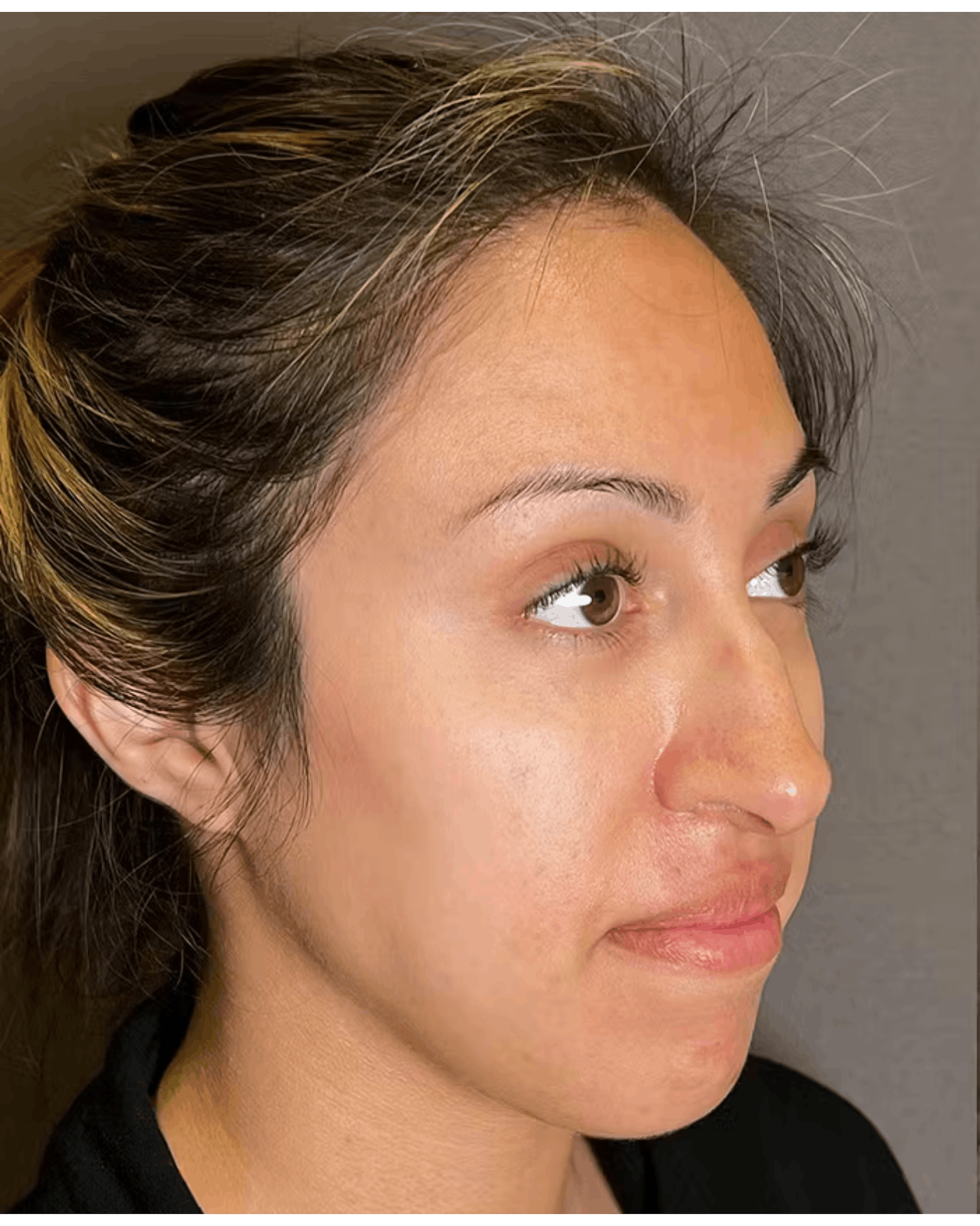Rhinoplasty Before & After Gallery - Patient 900363 - Image 3