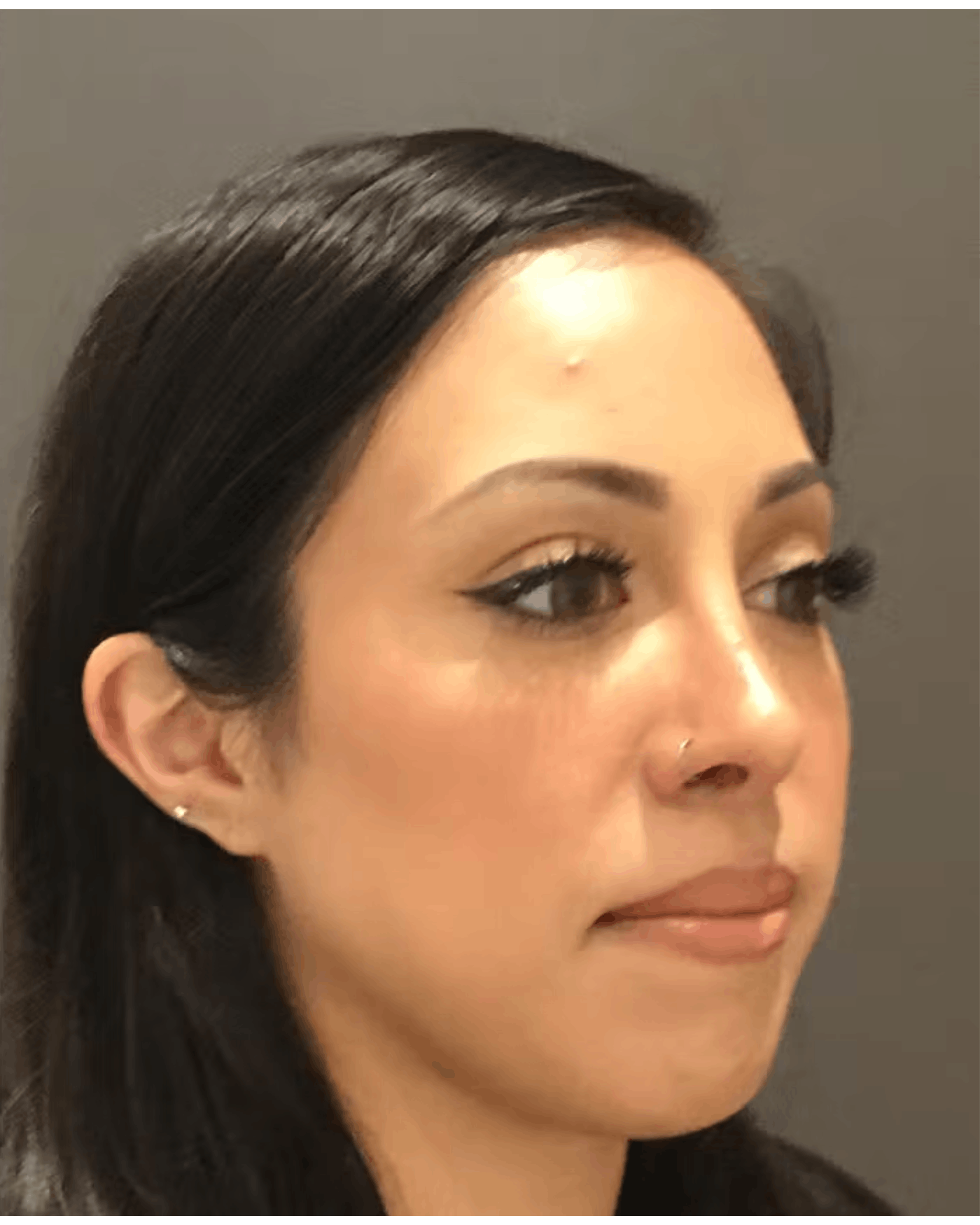 Rhinoplasty Before & After Gallery - Patient 900363 - Image 4
