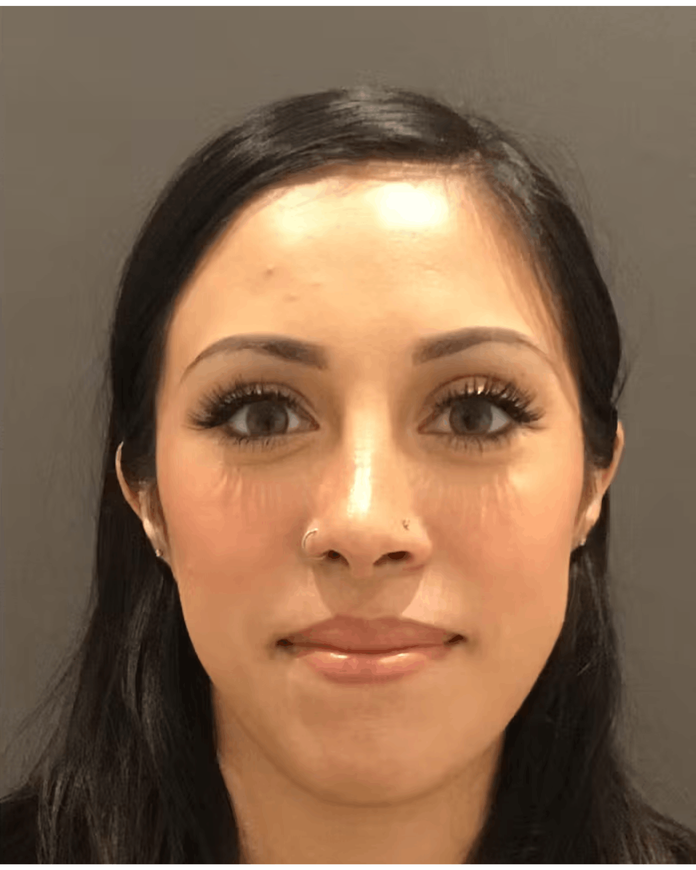 Rhinoplasty Before & After Gallery - Patient 900363 - Image 6