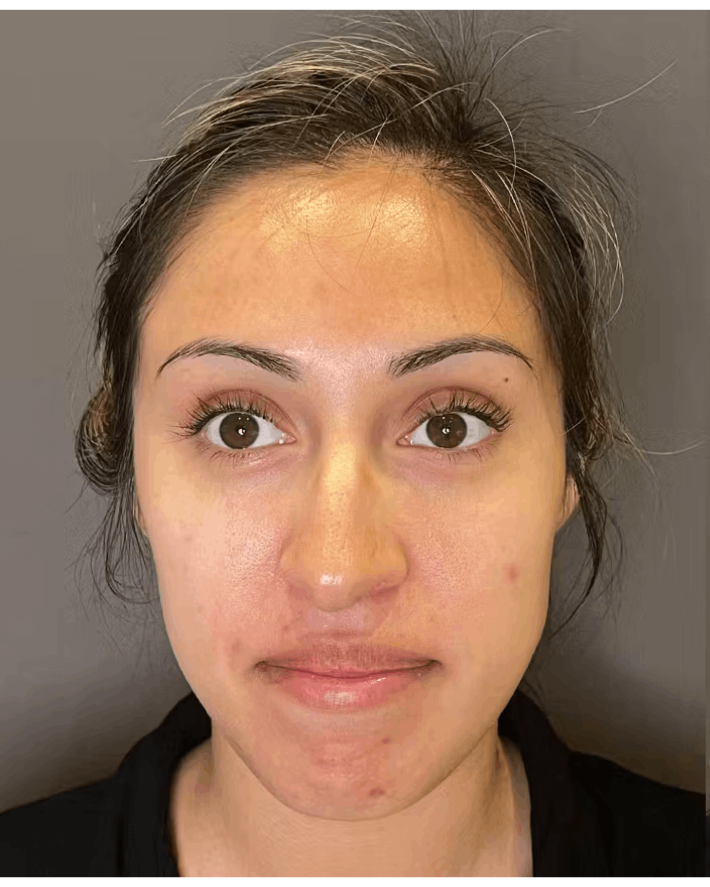 Rhinoplasty Before & After Gallery - Patient 900363 - Image 5