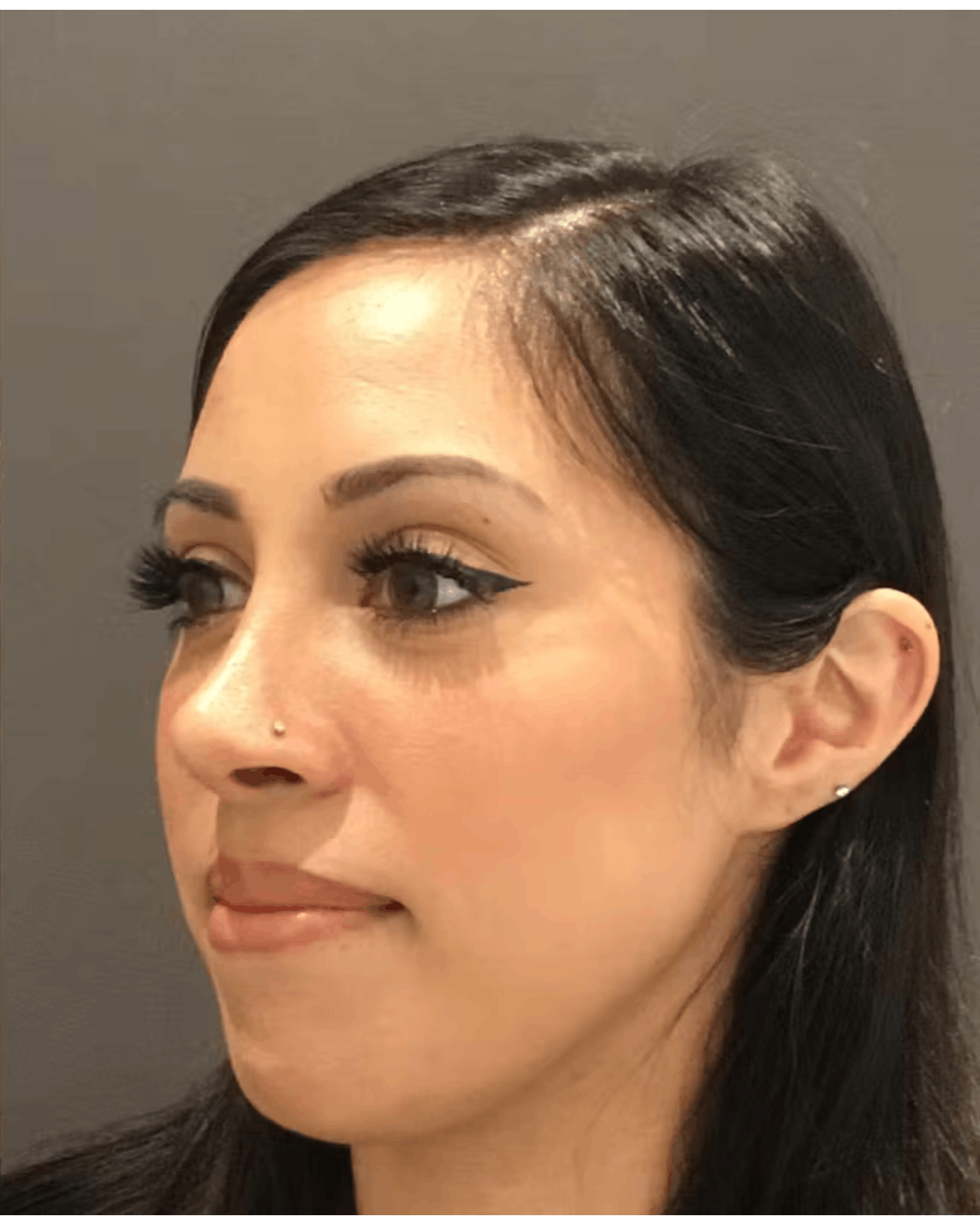 Rhinoplasty Before & After Gallery - Patient 900363 - Image 8