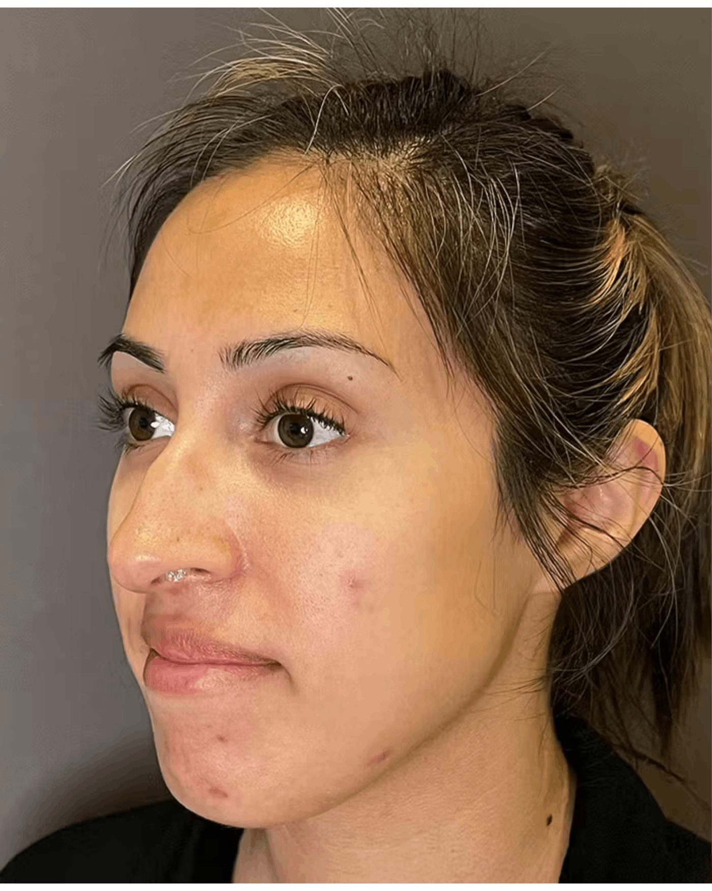 Rhinoplasty Before & After Gallery - Patient 900363 - Image 7