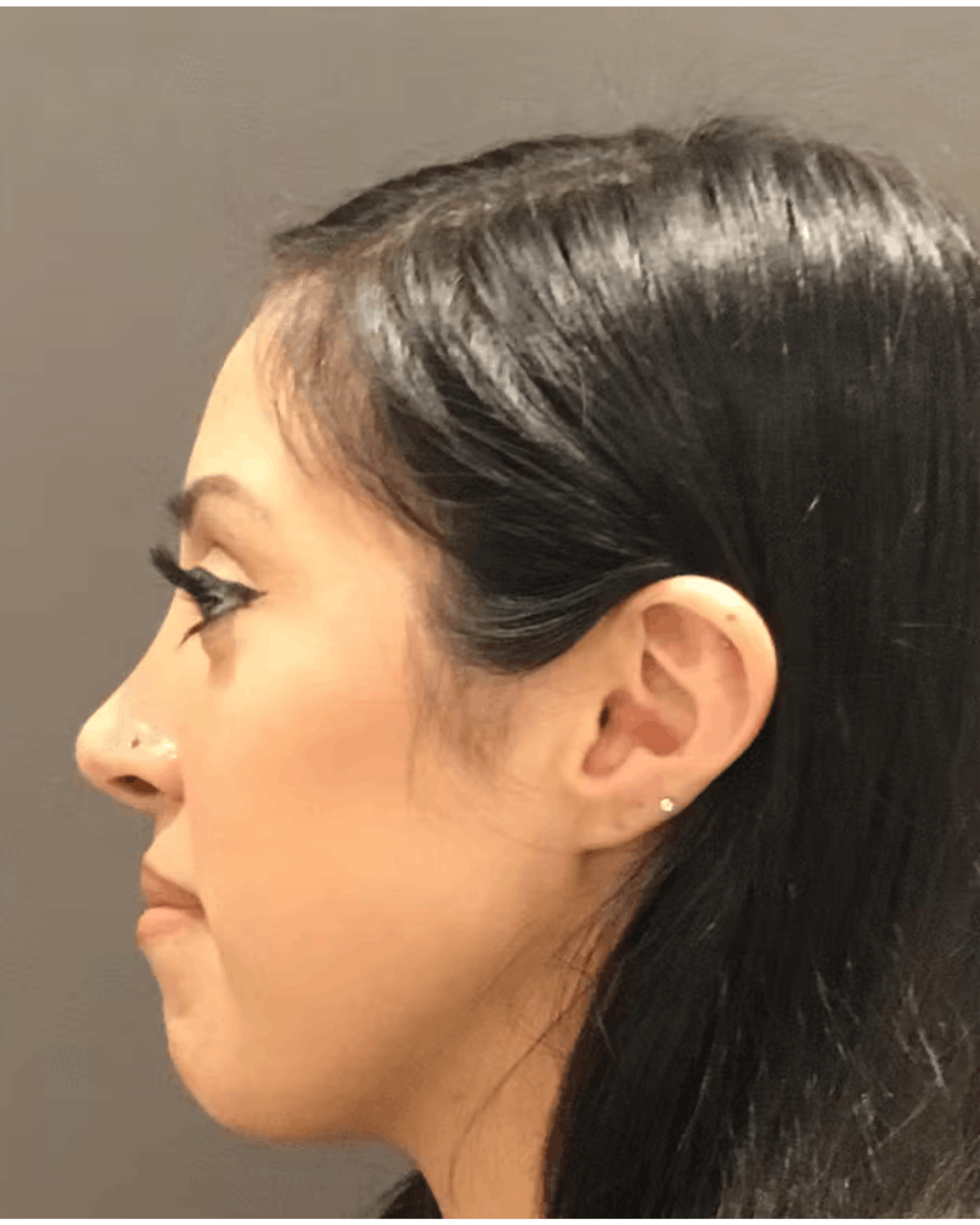 Rhinoplasty Before & After Gallery - Patient 900363 - Image 10