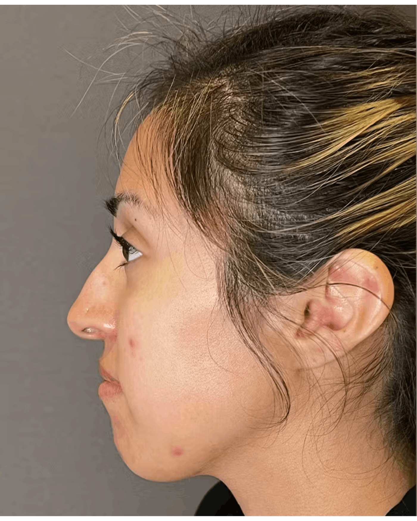 Rhinoplasty Before & After Gallery - Patient 900363 - Image 9