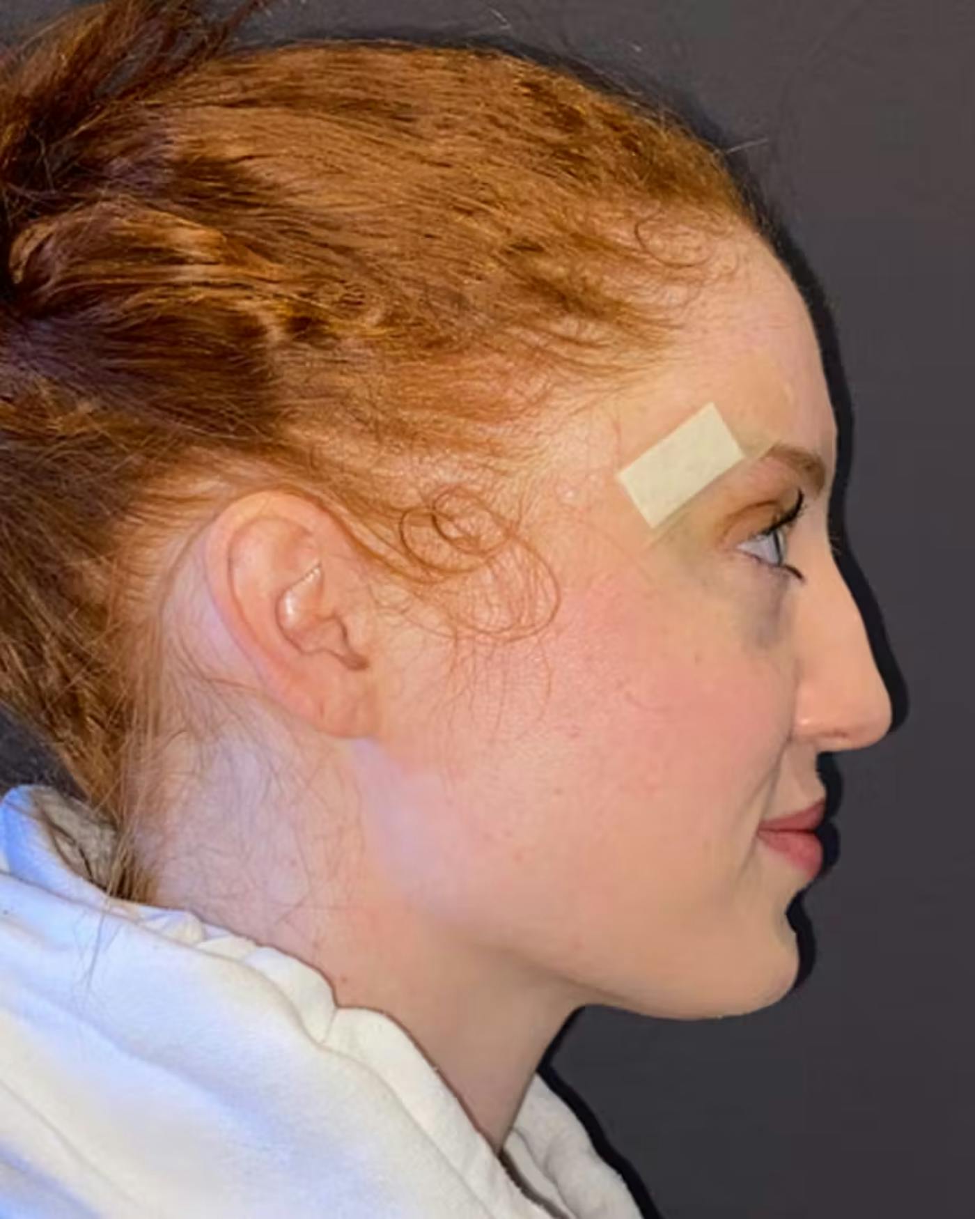 Rhinoplasty Before & After Gallery - Patient 348332 - Image 1
