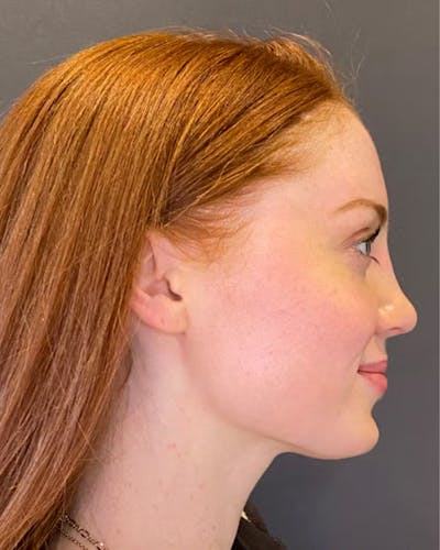 Rhinoplasty Before & After Gallery - Patient 348332 - Image 2