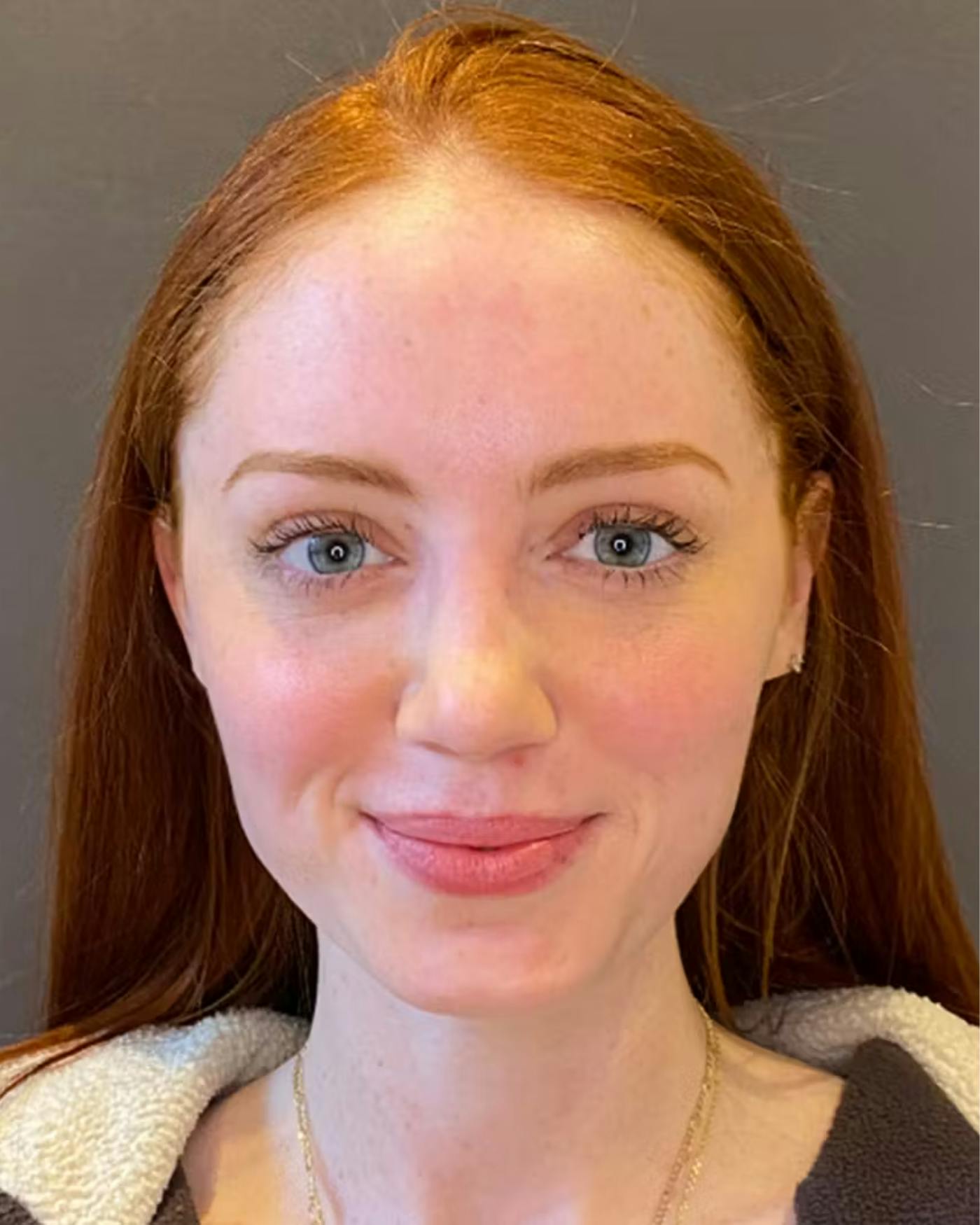 Rhinoplasty Before & After Gallery - Patient 348332 - Image 6