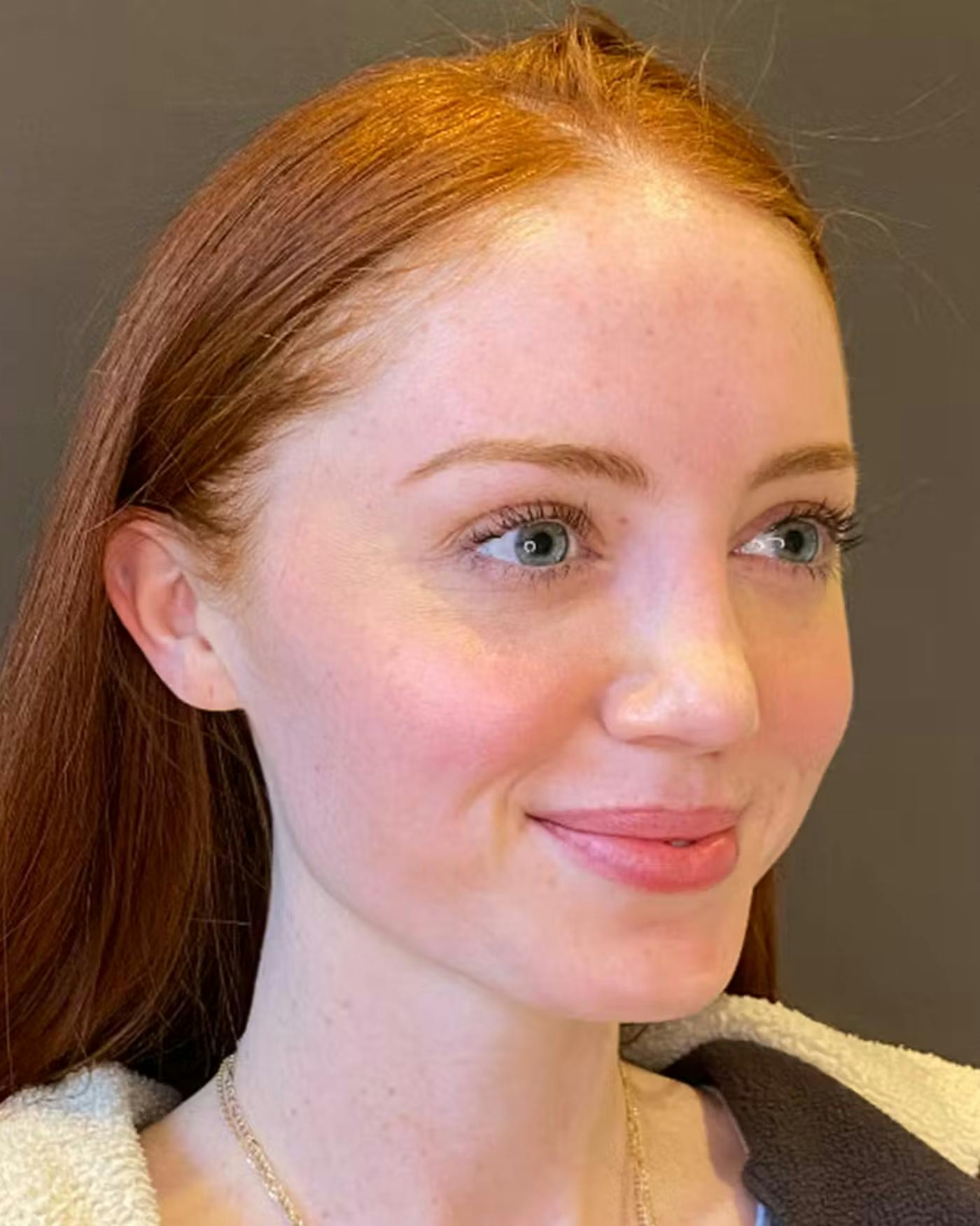 Rhinoplasty Before & After Gallery - Patient 348332 - Image 4