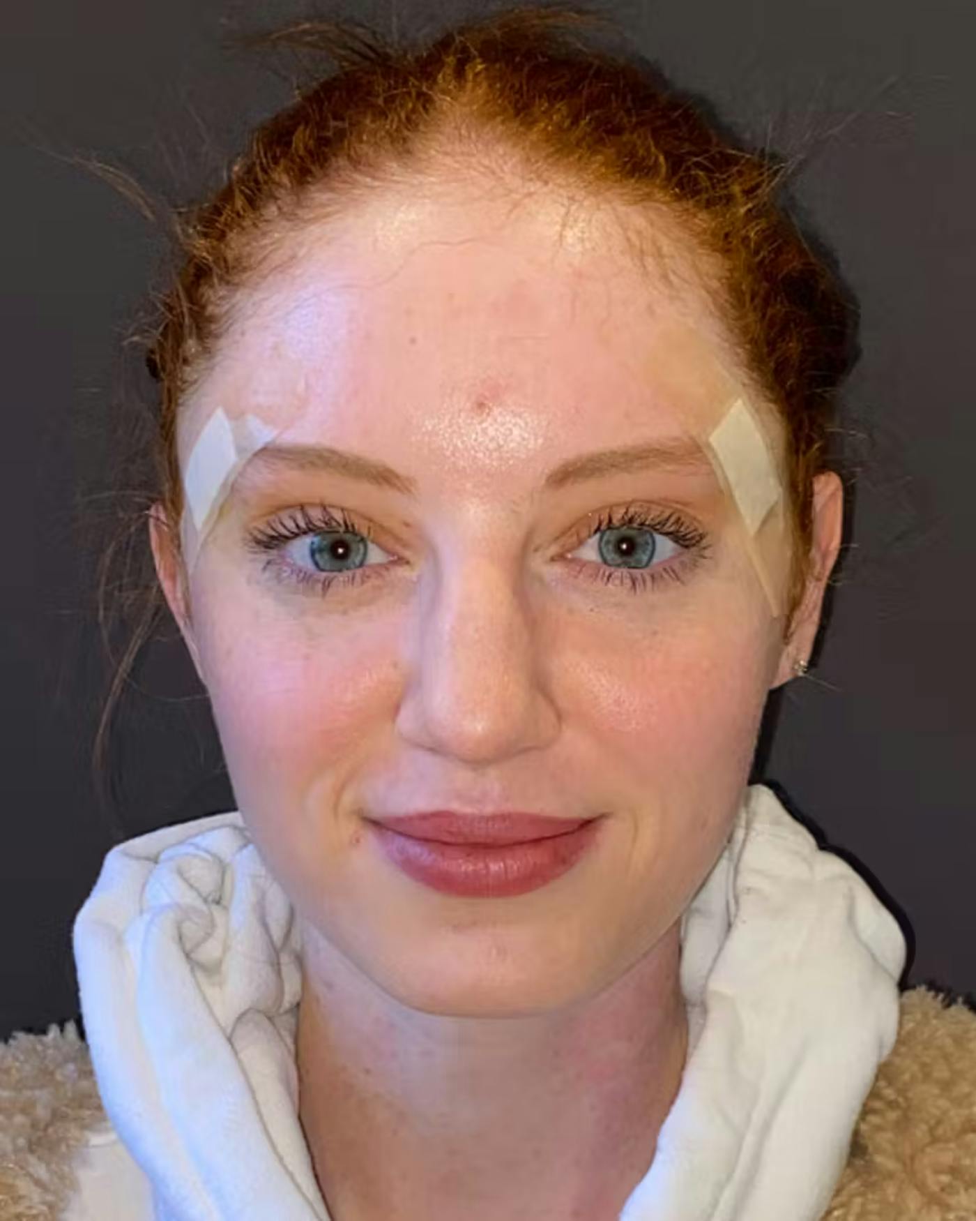 Rhinoplasty Before & After Gallery - Patient 348332 - Image 5