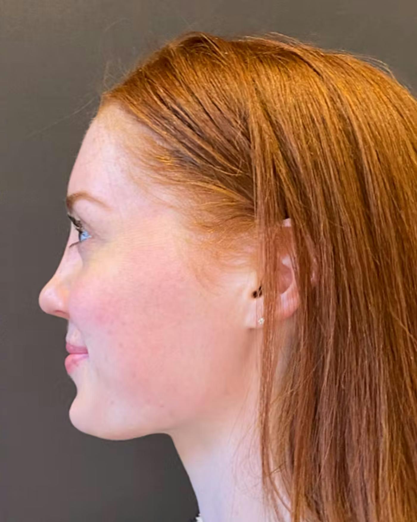 Rhinoplasty Before & After Gallery - Patient 348332 - Image 10