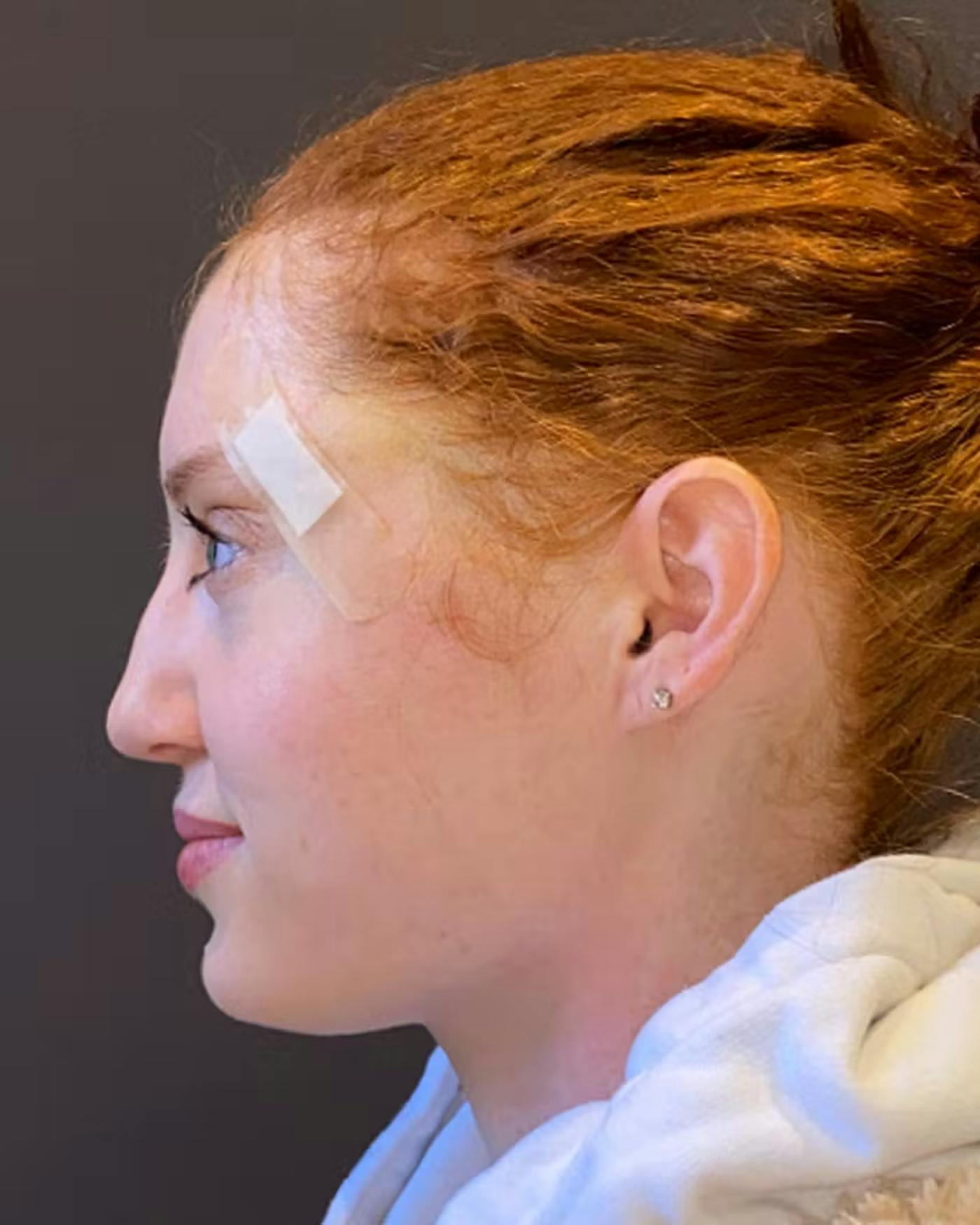 Rhinoplasty Before & After Gallery - Patient 348332 - Image 9