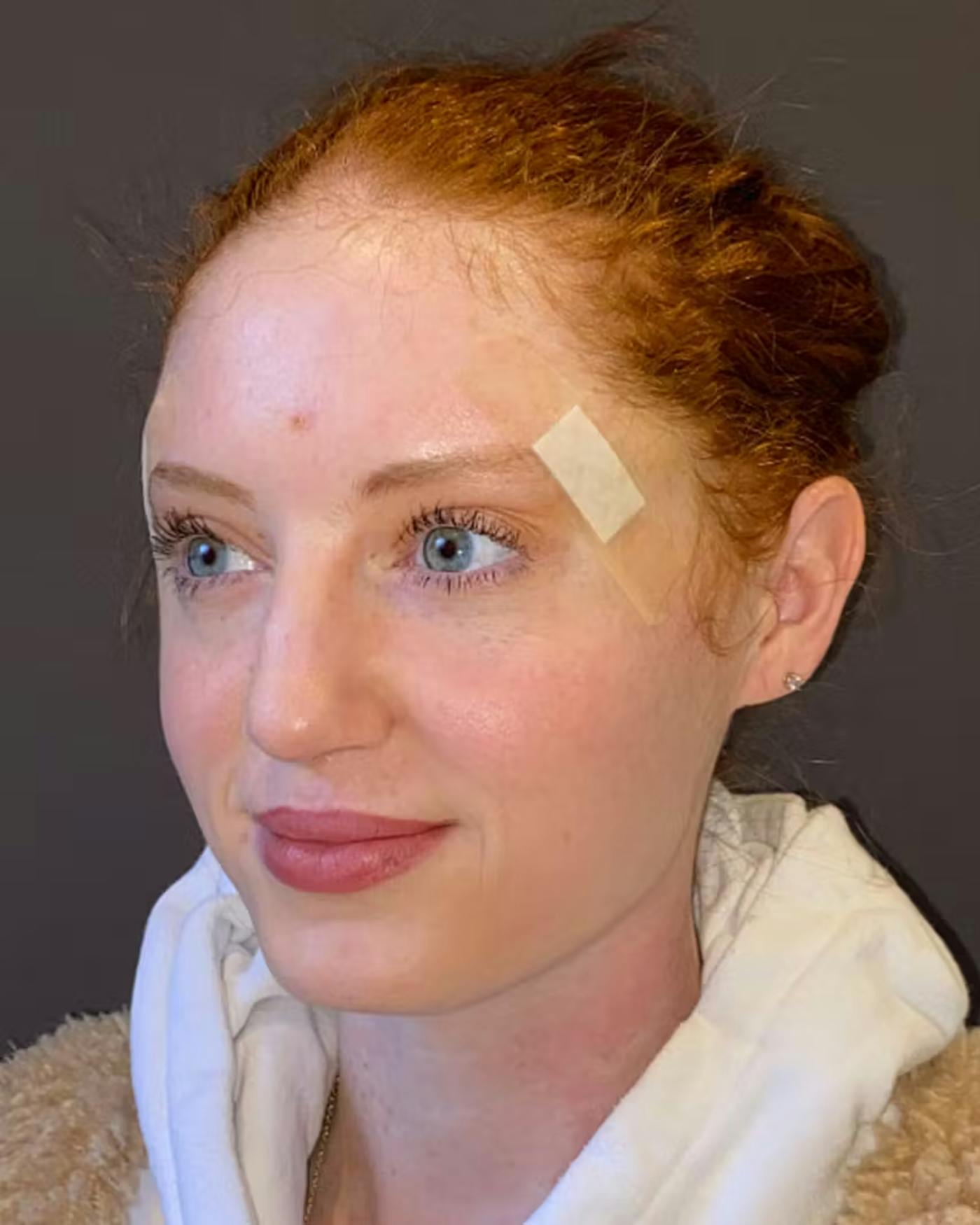 Rhinoplasty Before & After Gallery - Patient 348332 - Image 7