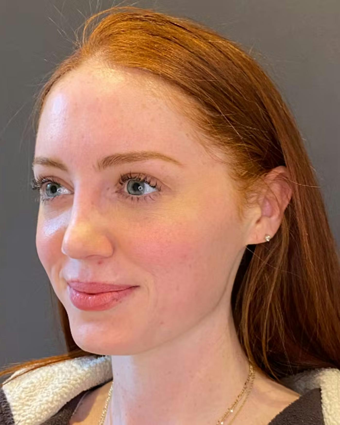 Rhinoplasty Before & After Gallery - Patient 348332 - Image 8