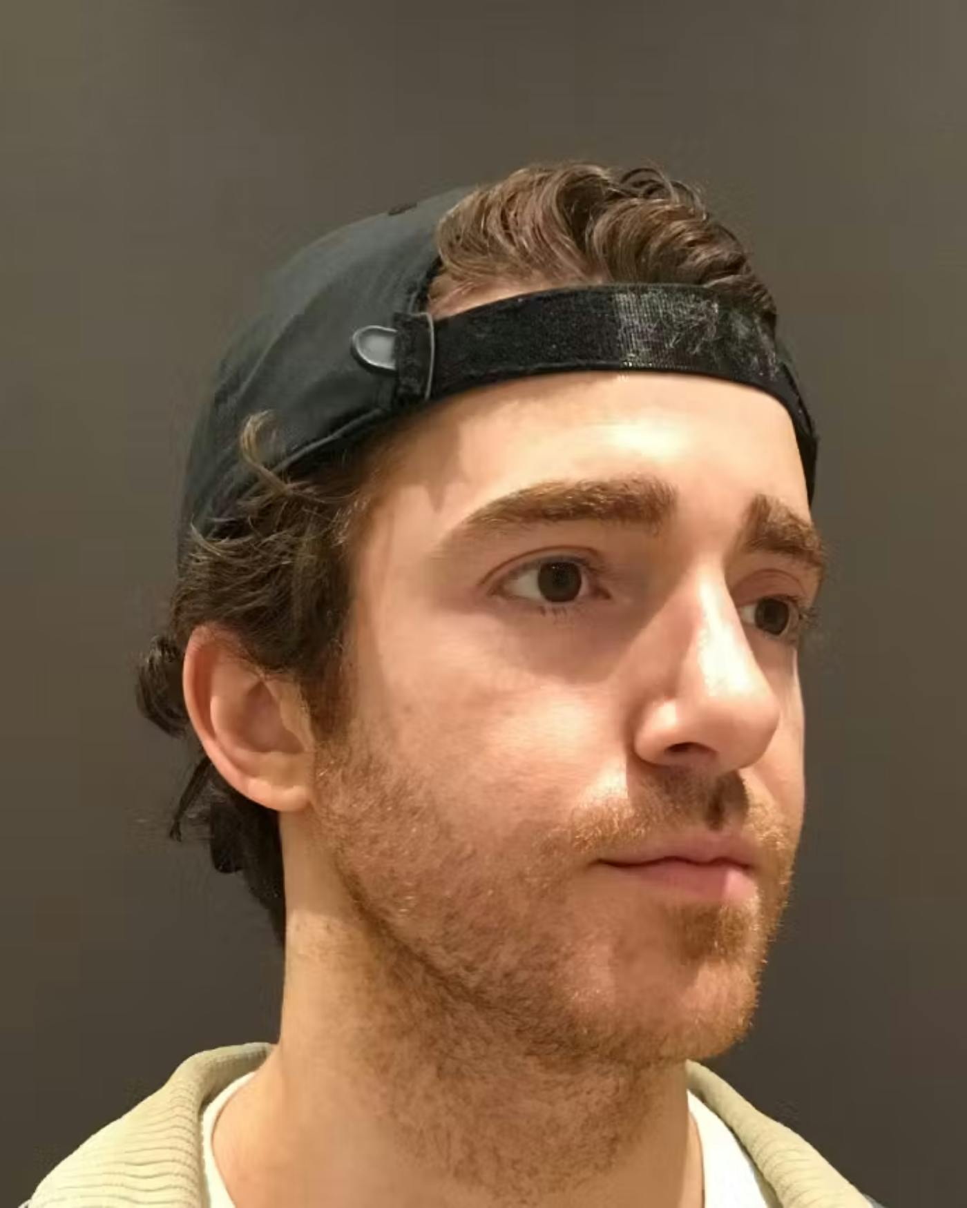 Rhinoplasty Before & After Gallery - Patient 422489 - Image 4