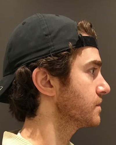 Rhinoplasty Before & After Gallery - Patient 422489 - Image 2
