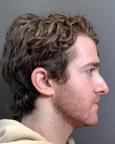 Rhinoplasty Before & After Gallery - Patient 422489 - Image 1