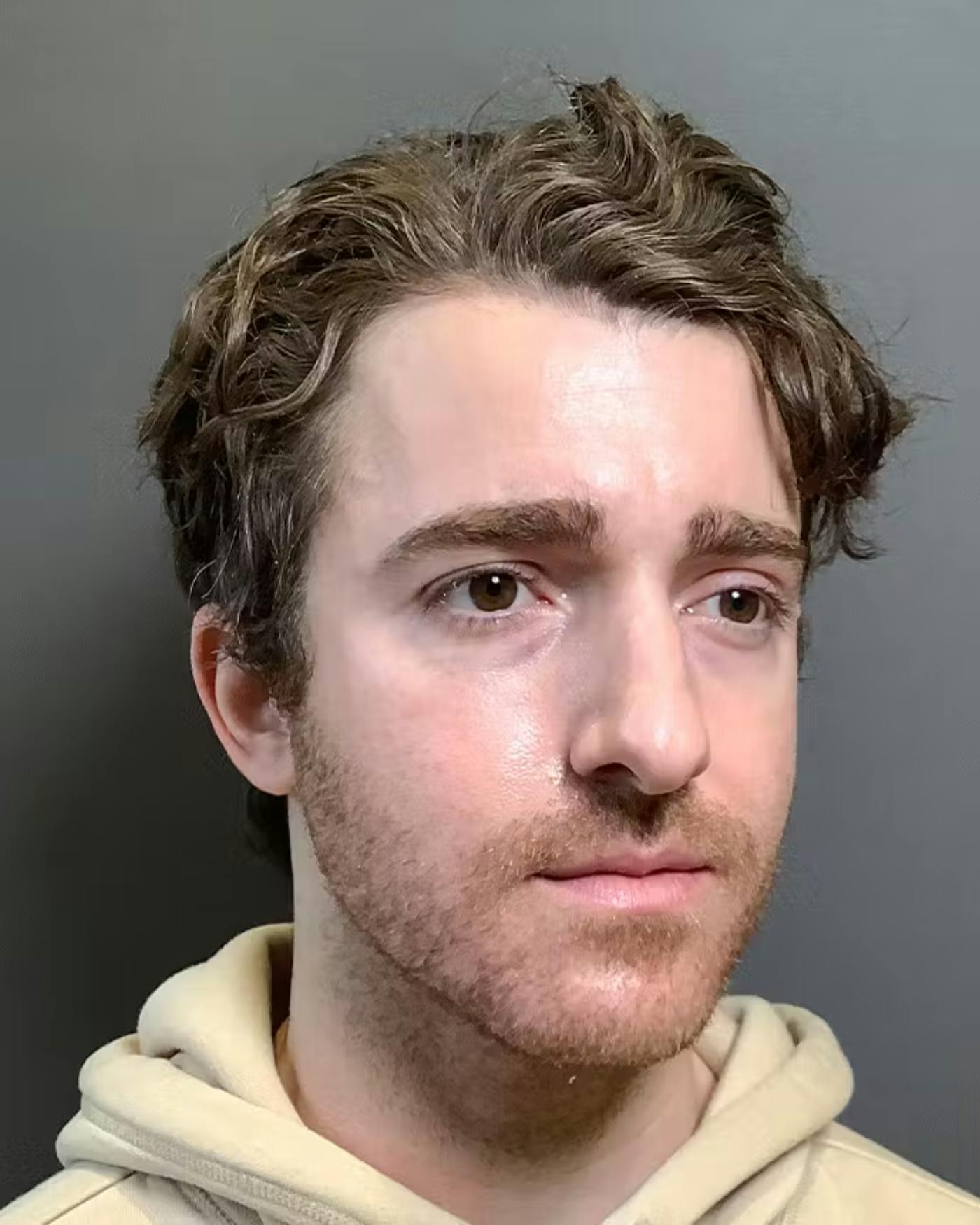 Rhinoplasty Before & After Gallery - Patient 422489 - Image 3