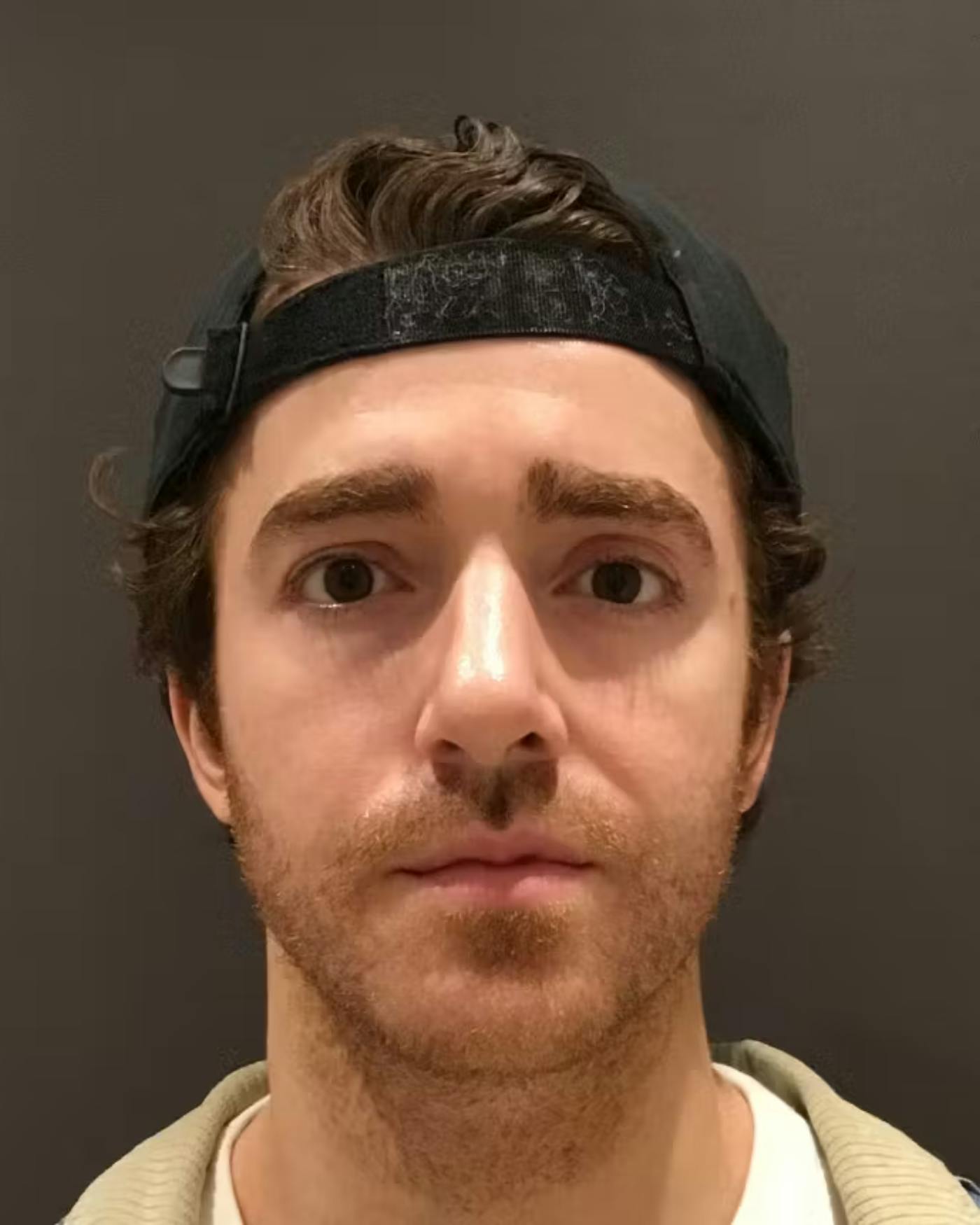 Rhinoplasty Before & After Gallery - Patient 422489 - Image 6