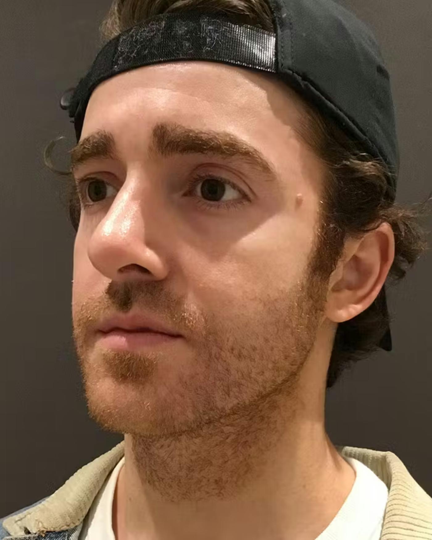 Rhinoplasty Before & After Gallery - Patient 422489 - Image 8