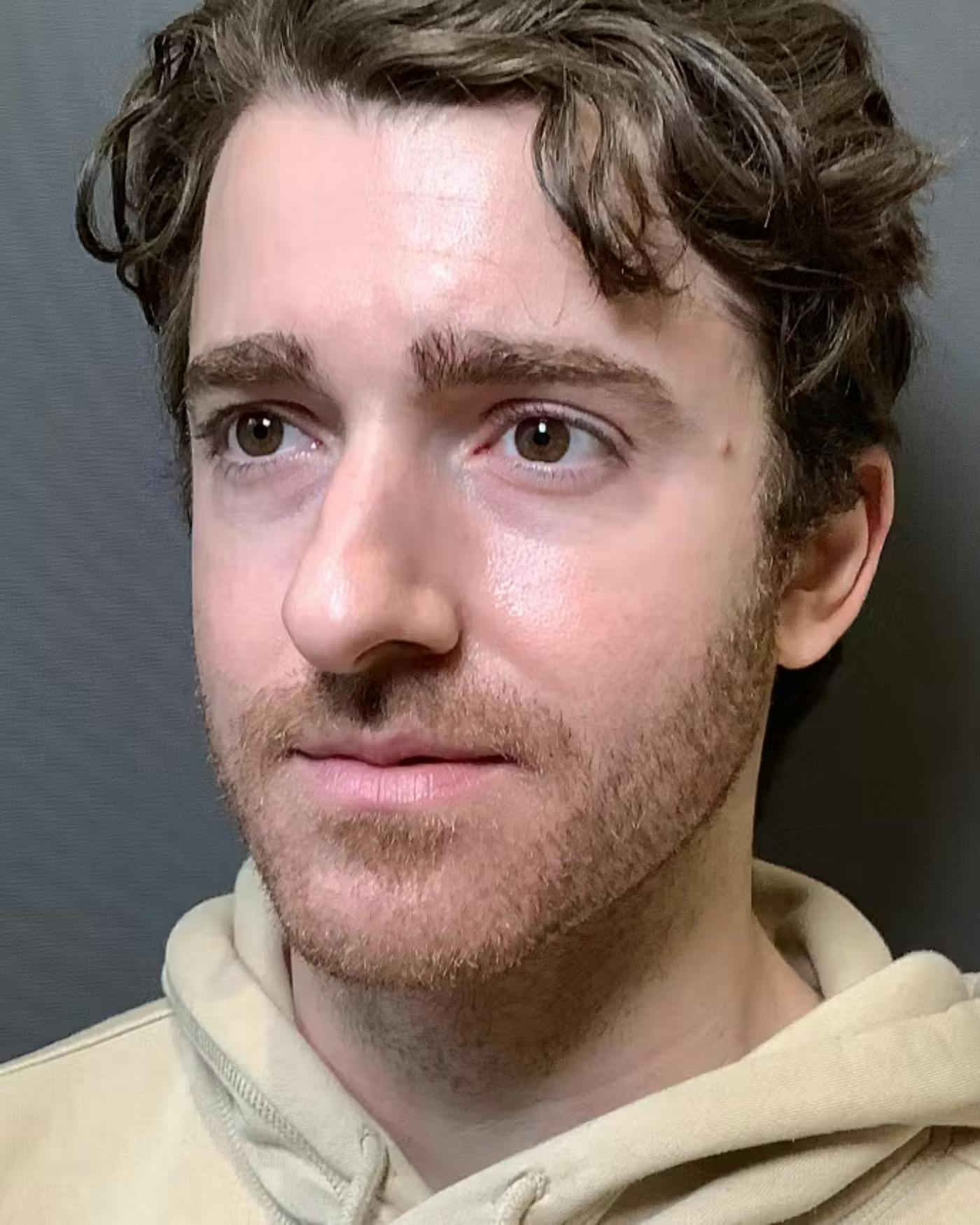 Rhinoplasty Before & After Gallery - Patient 422489 - Image 7