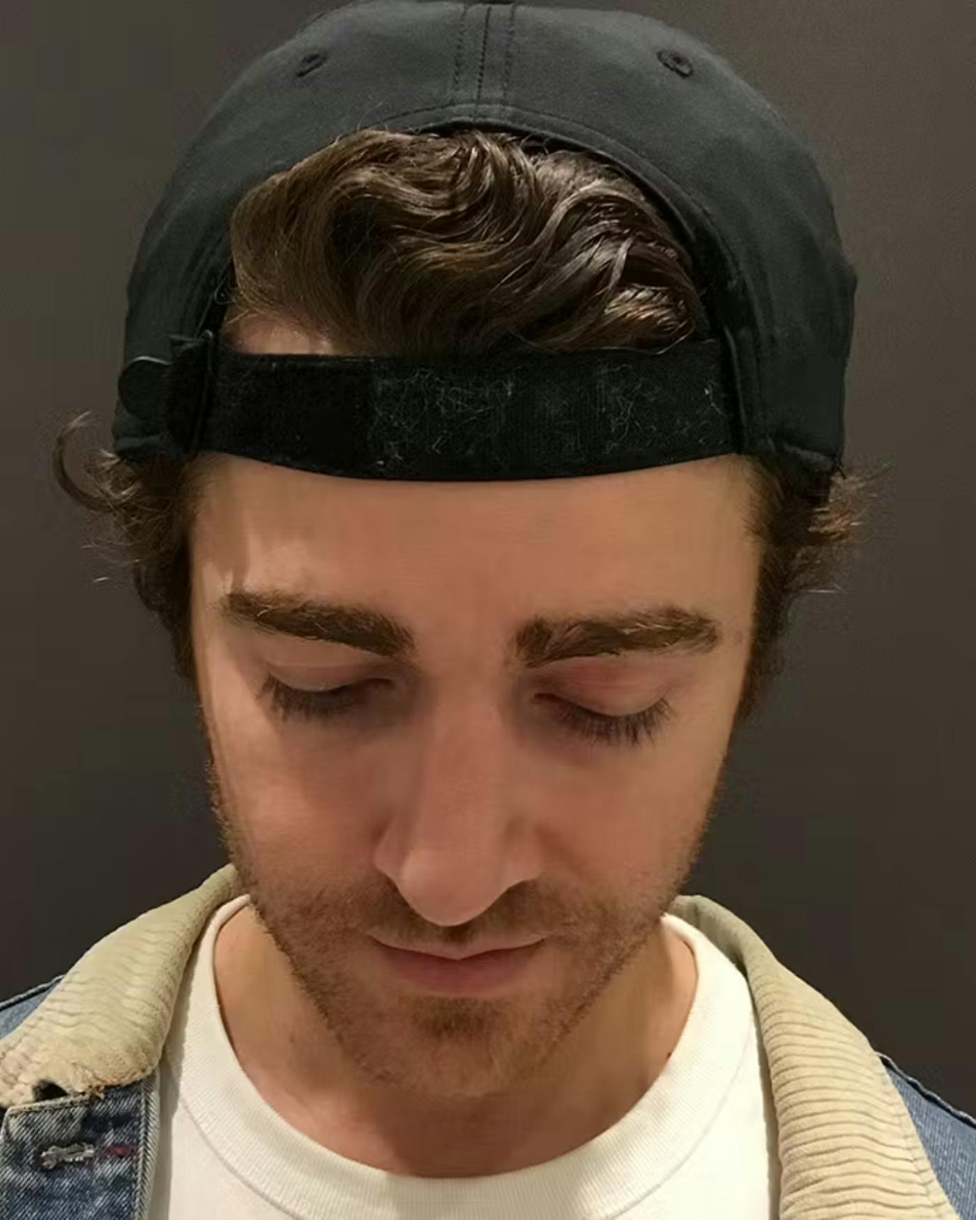 Rhinoplasty Before & After Gallery - Patient 422489 - Image 10