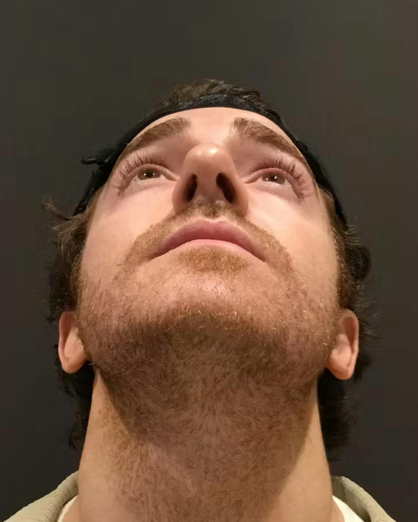 Rhinoplasty Before & After Gallery - Patient 422489 - Image 12