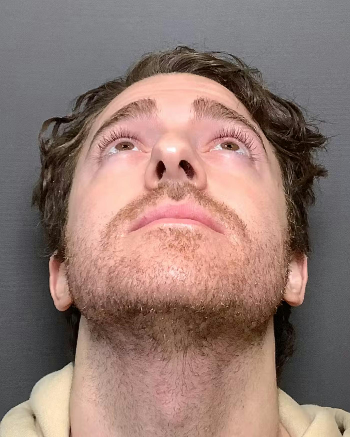 Rhinoplasty Before & After Gallery - Patient 422489 - Image 11