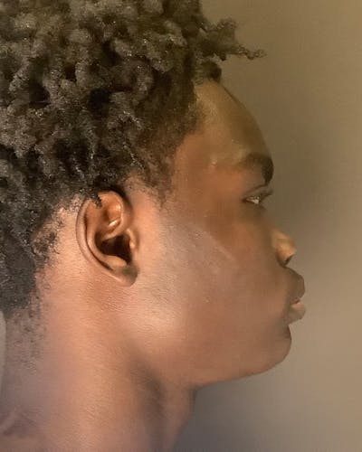 Rhinoplasty Before & After Gallery - Patient 788730 - Image 1