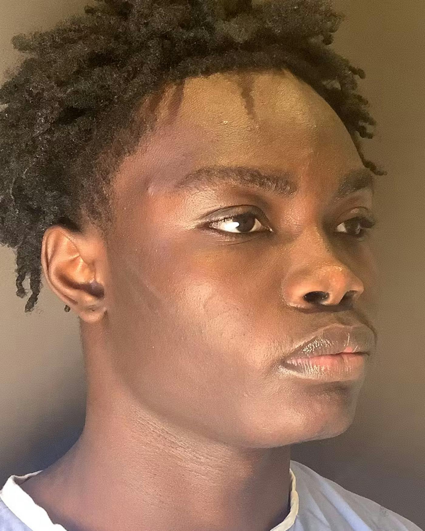 Rhinoplasty Before & After Gallery - Patient 788730 - Image 3