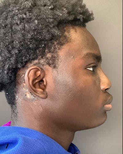 Rhinoplasty Before & After Gallery - Patient 788730 - Image 2