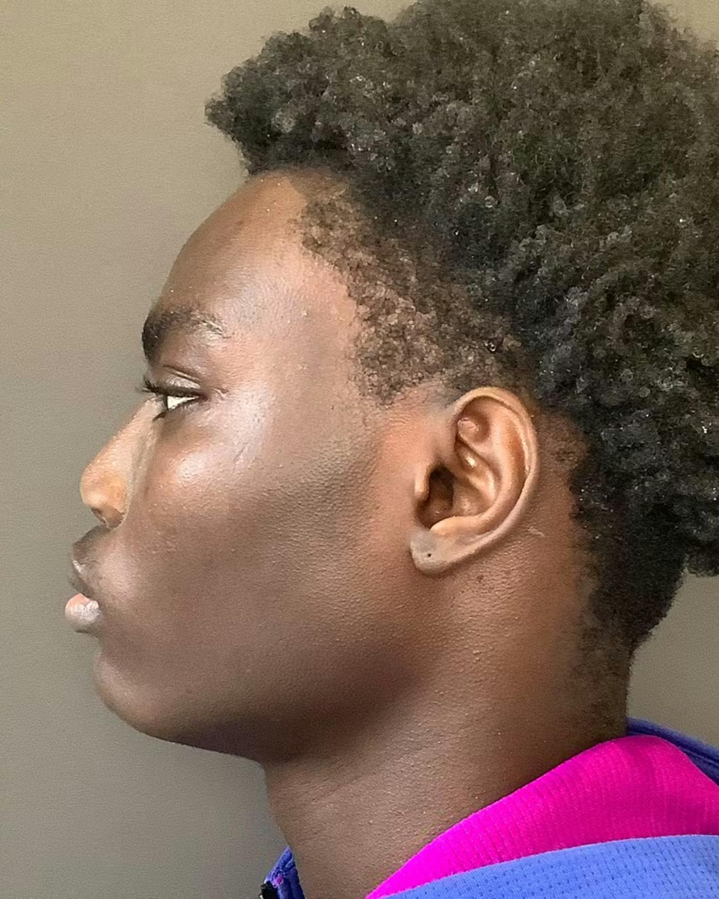 Rhinoplasty Before & After Gallery - Patient 788730 - Image 10