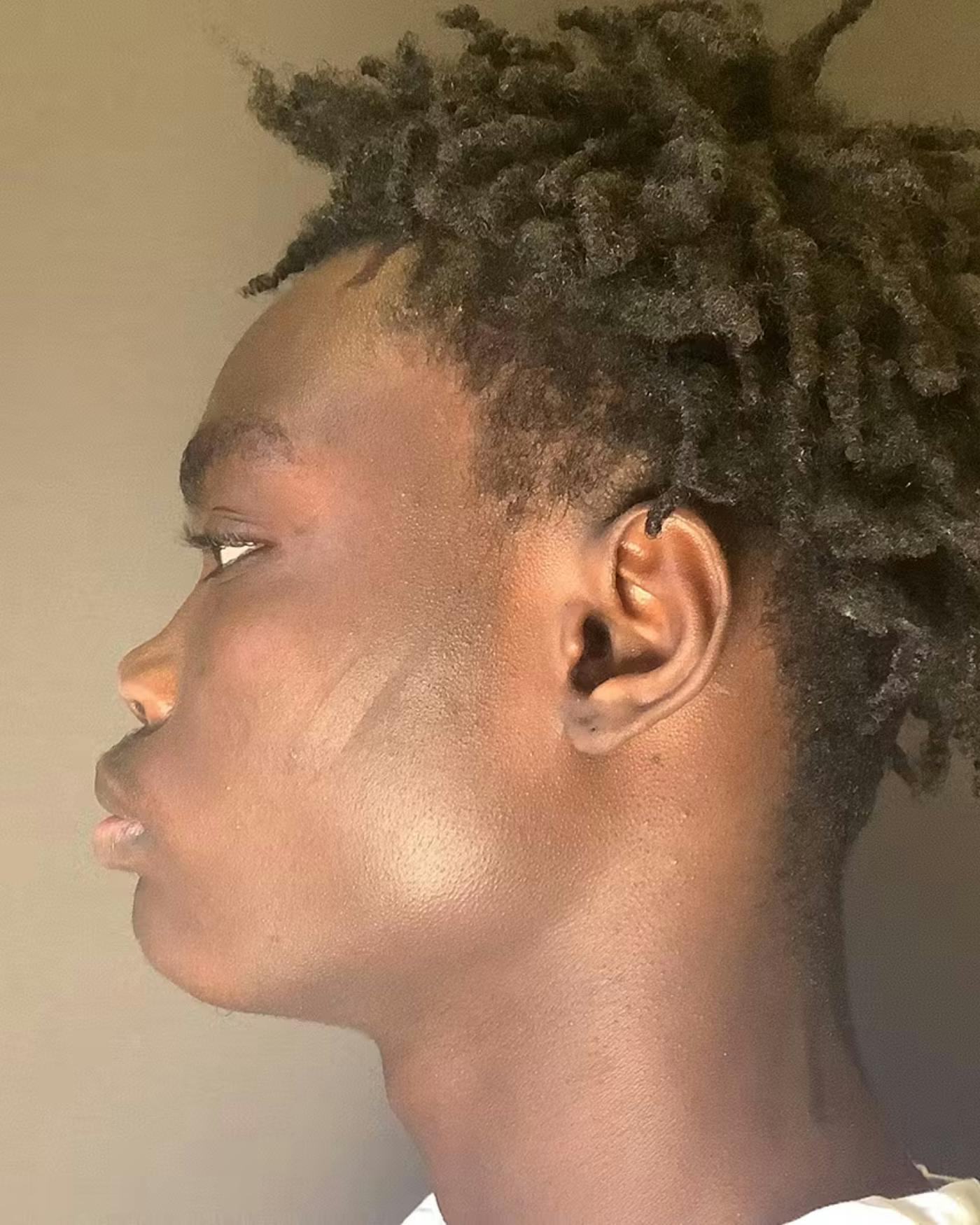 Rhinoplasty Before & After Gallery - Patient 788730 - Image 9