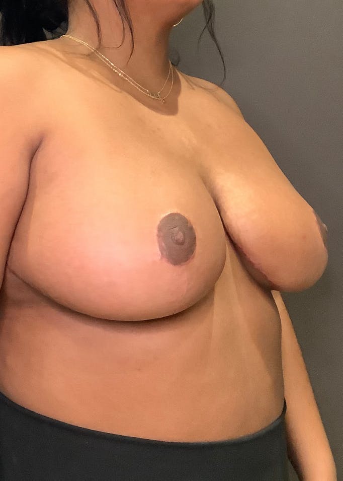 Breast Reduction Before & After Gallery - Patient 393984 - Image 4