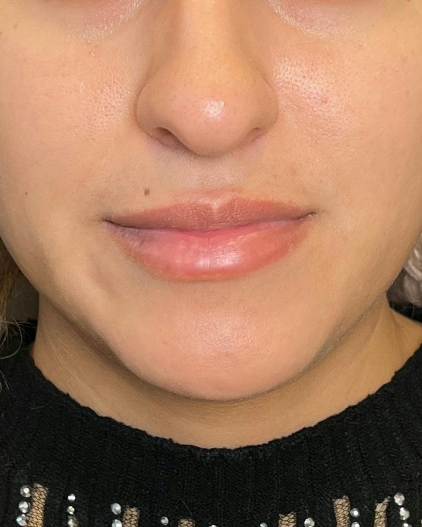 Lip Lift / Lip Reduction Before & After Gallery - Patient 310400 - Image 1