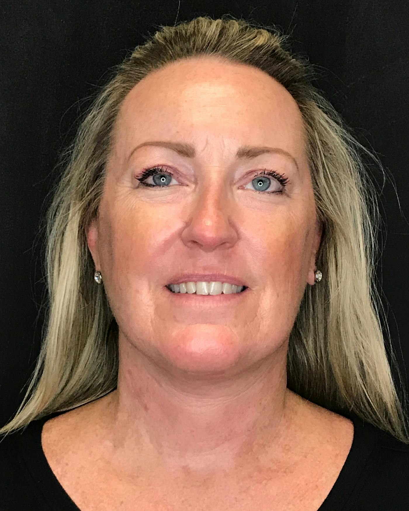 Facelifts / Necklift Before & After Gallery - Patient 286332 - Image 4