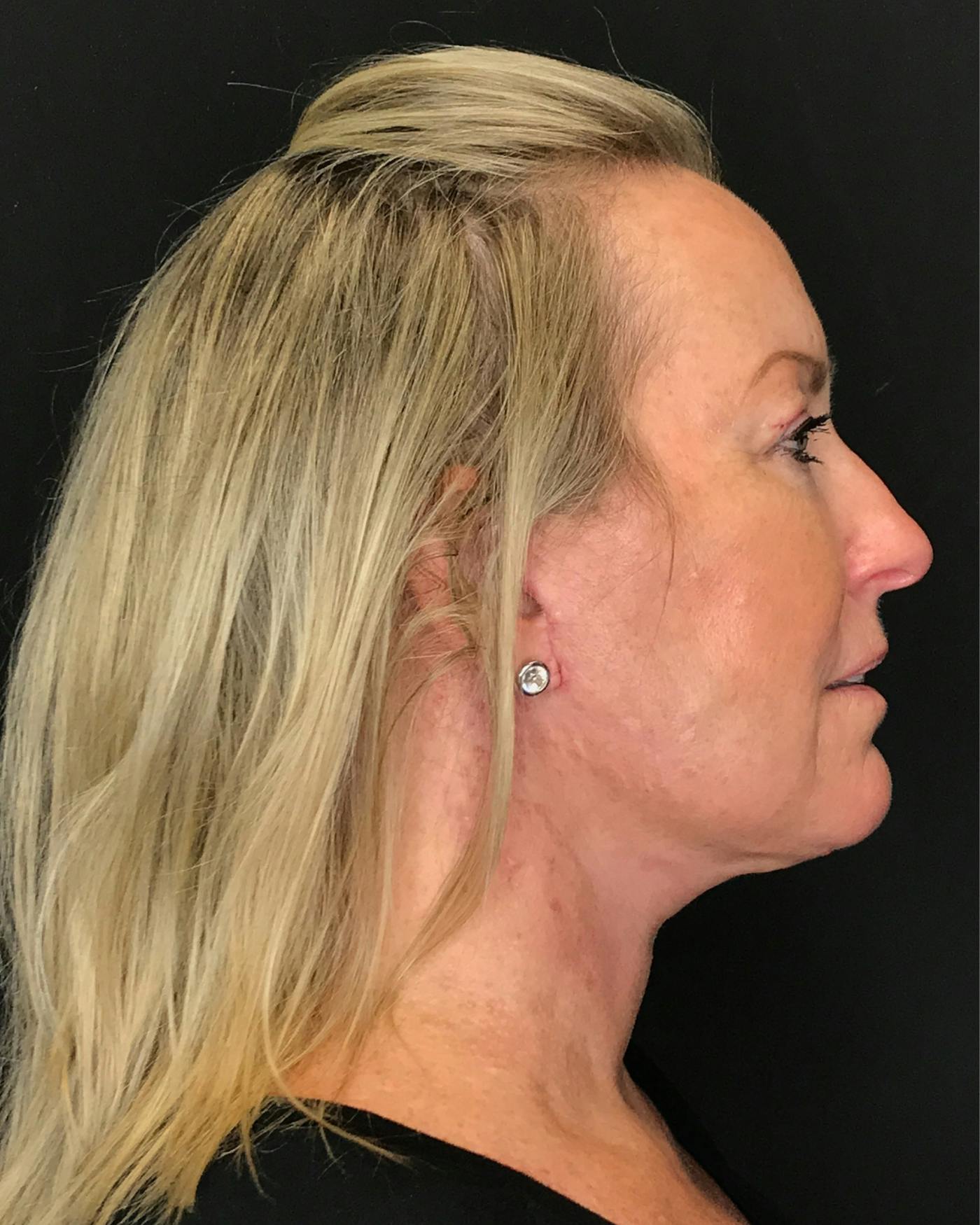 Facelifts / Necklift Before & After Gallery - Patient 286332 - Image 2