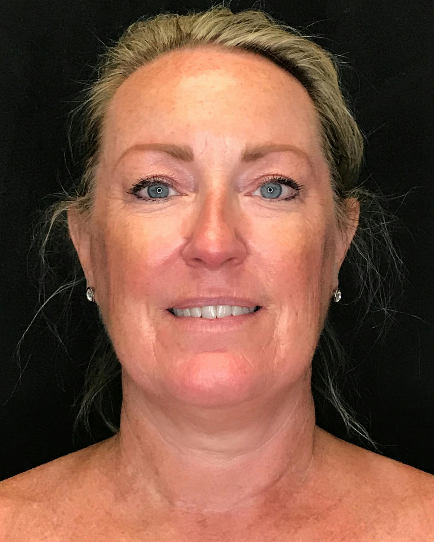 Facelifts / Necklift Before & After Gallery - Patient 286332 - Image 3