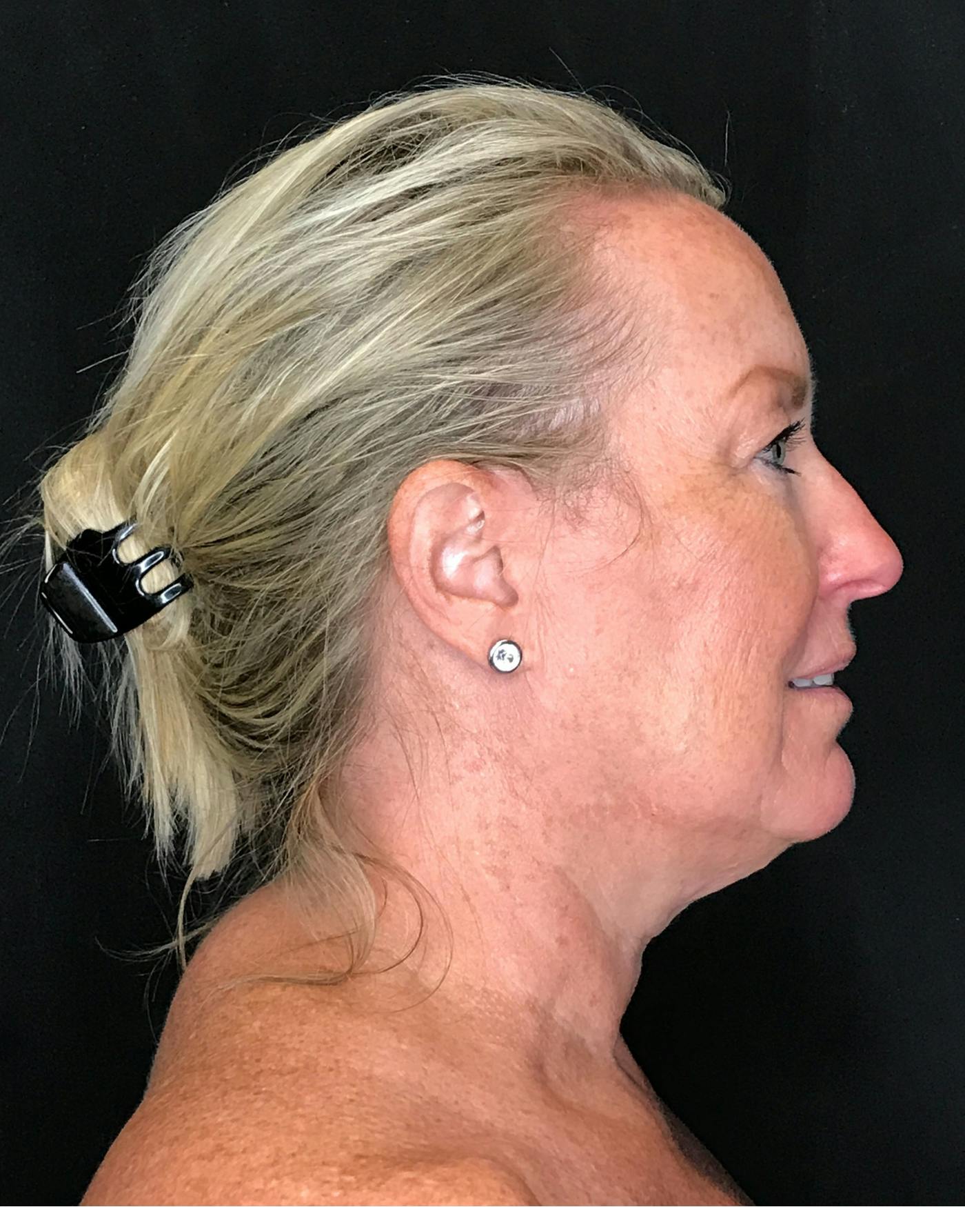Facelifts / Necklift Before & After Gallery - Patient 286332 - Image 1
