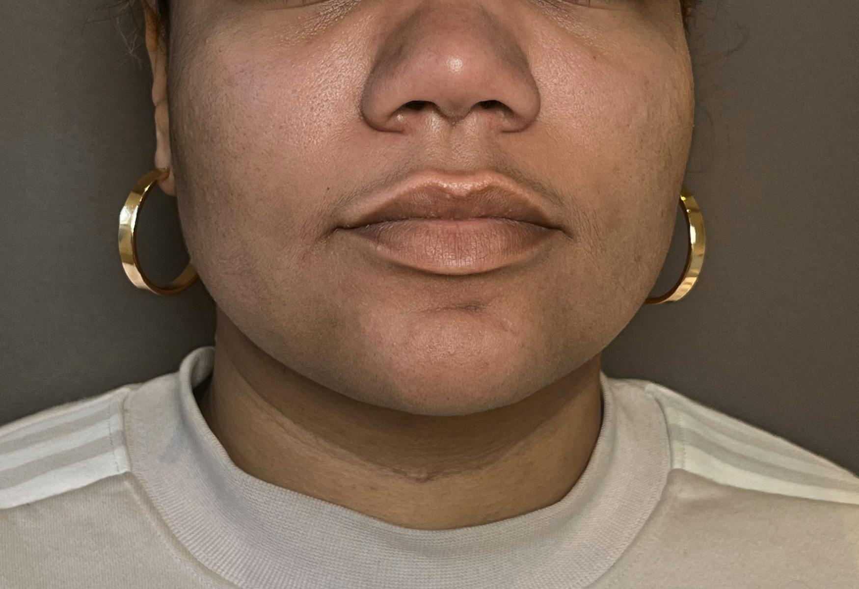 Liposuction Before & After Gallery - Patient 175992 - Image 2