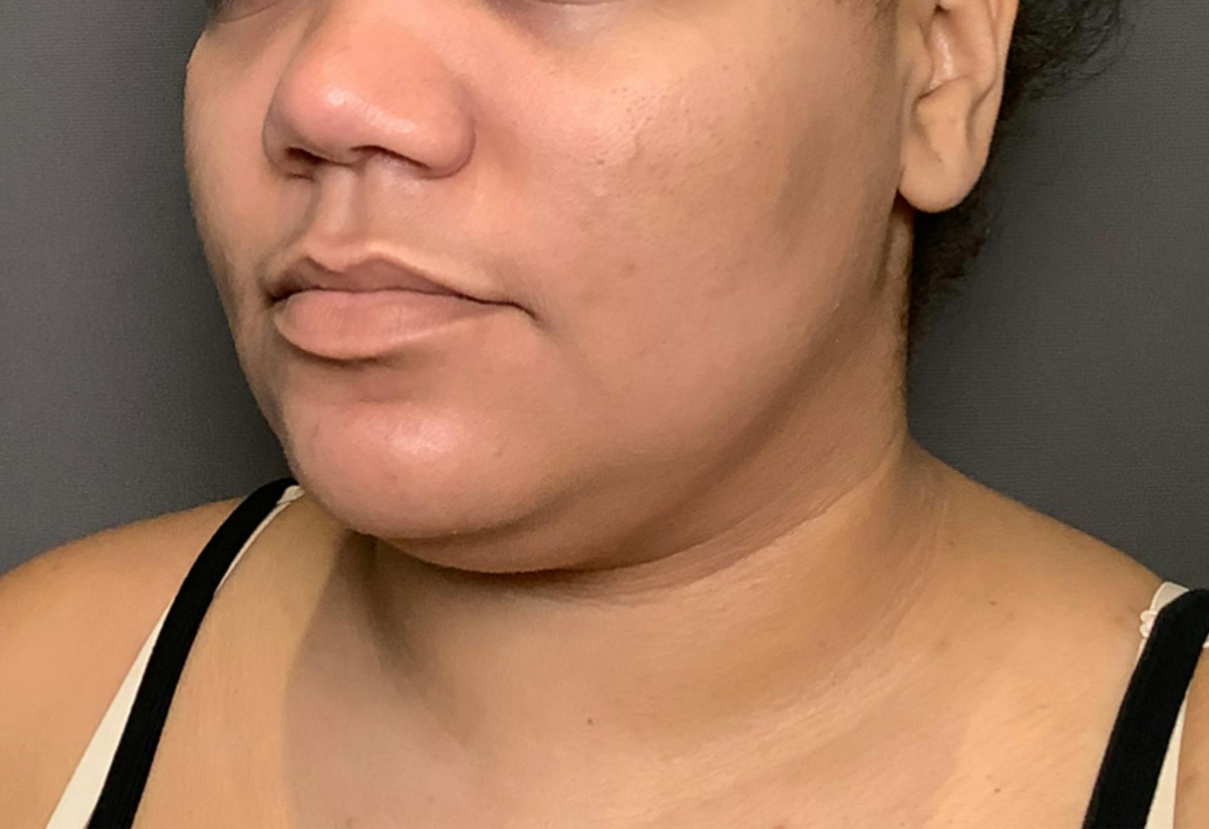 Liposuction Before & After Gallery - Patient 175992 - Image 7