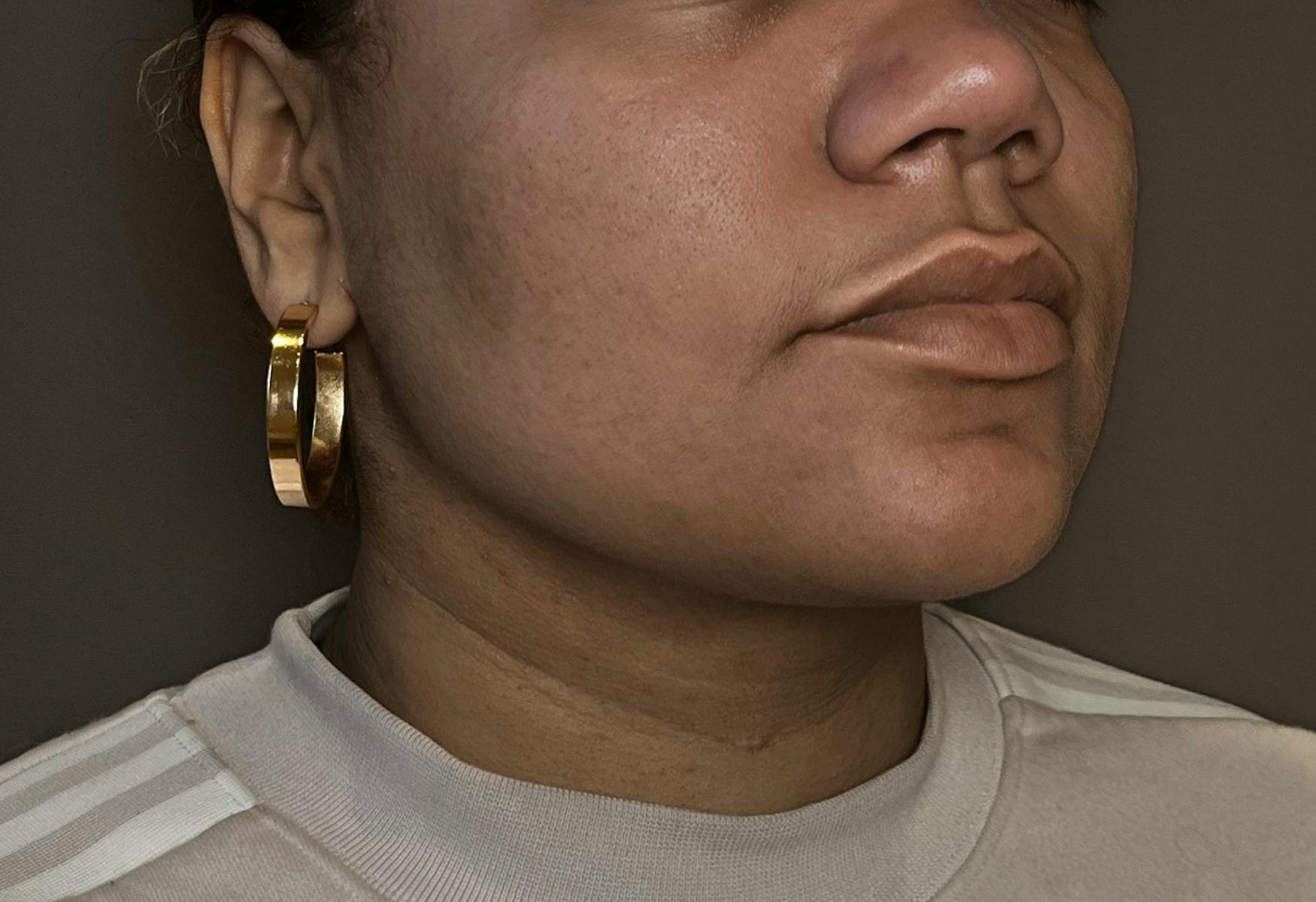 Liposuction Before & After Gallery - Patient 175992 - Image 4