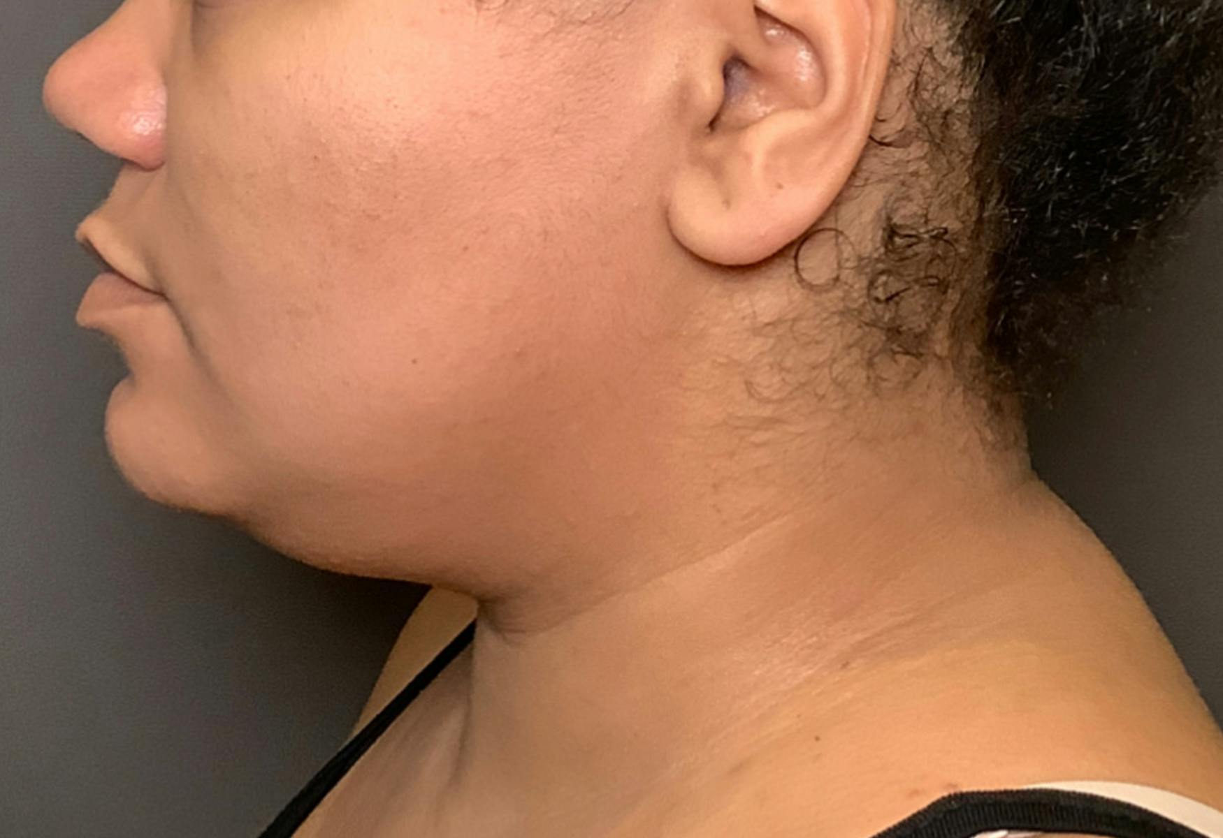 Liposuction Before & After Gallery - Patient 175992 - Image 9