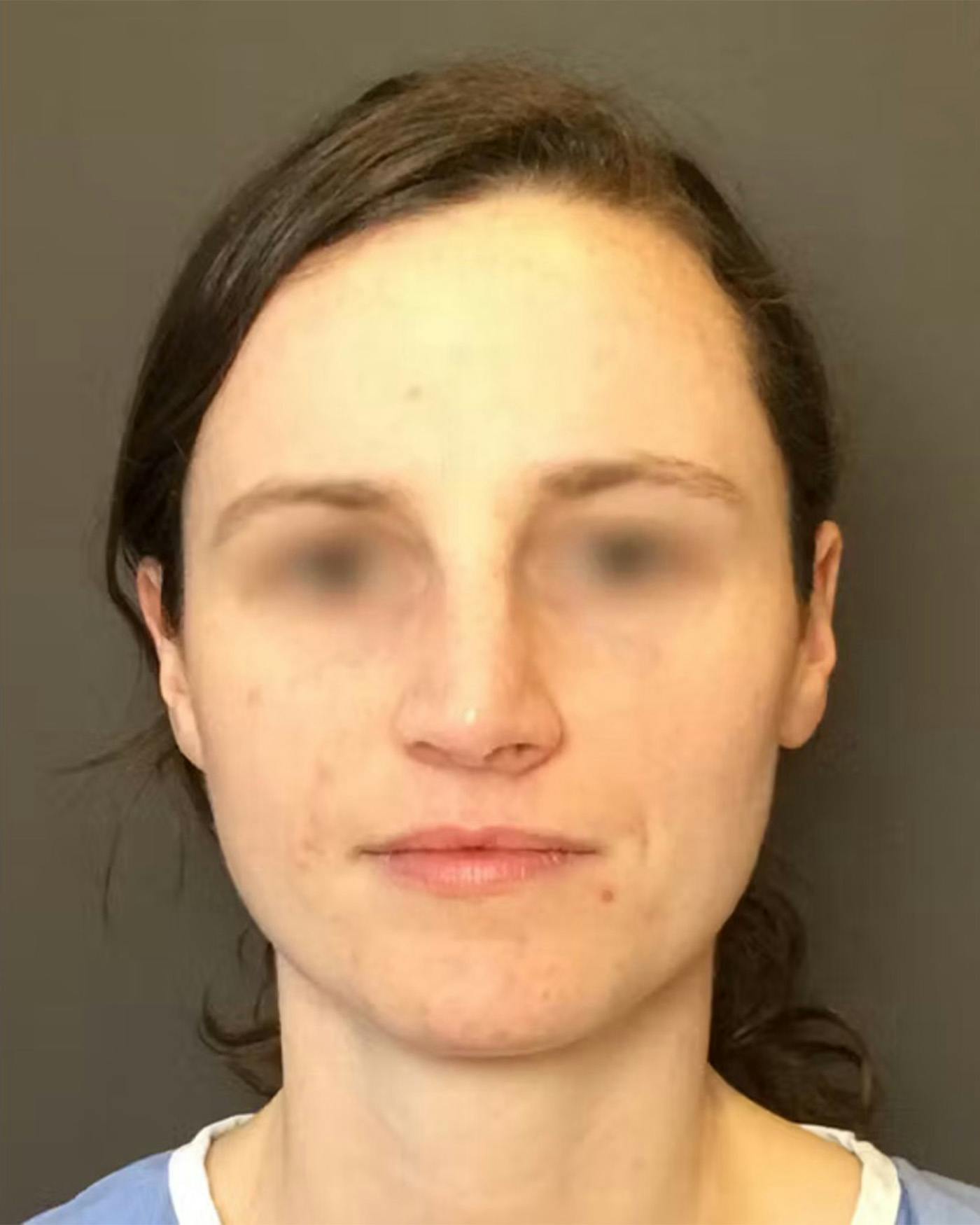 Rhinoplasty Before & After Gallery - Patient 172023 - Image 5