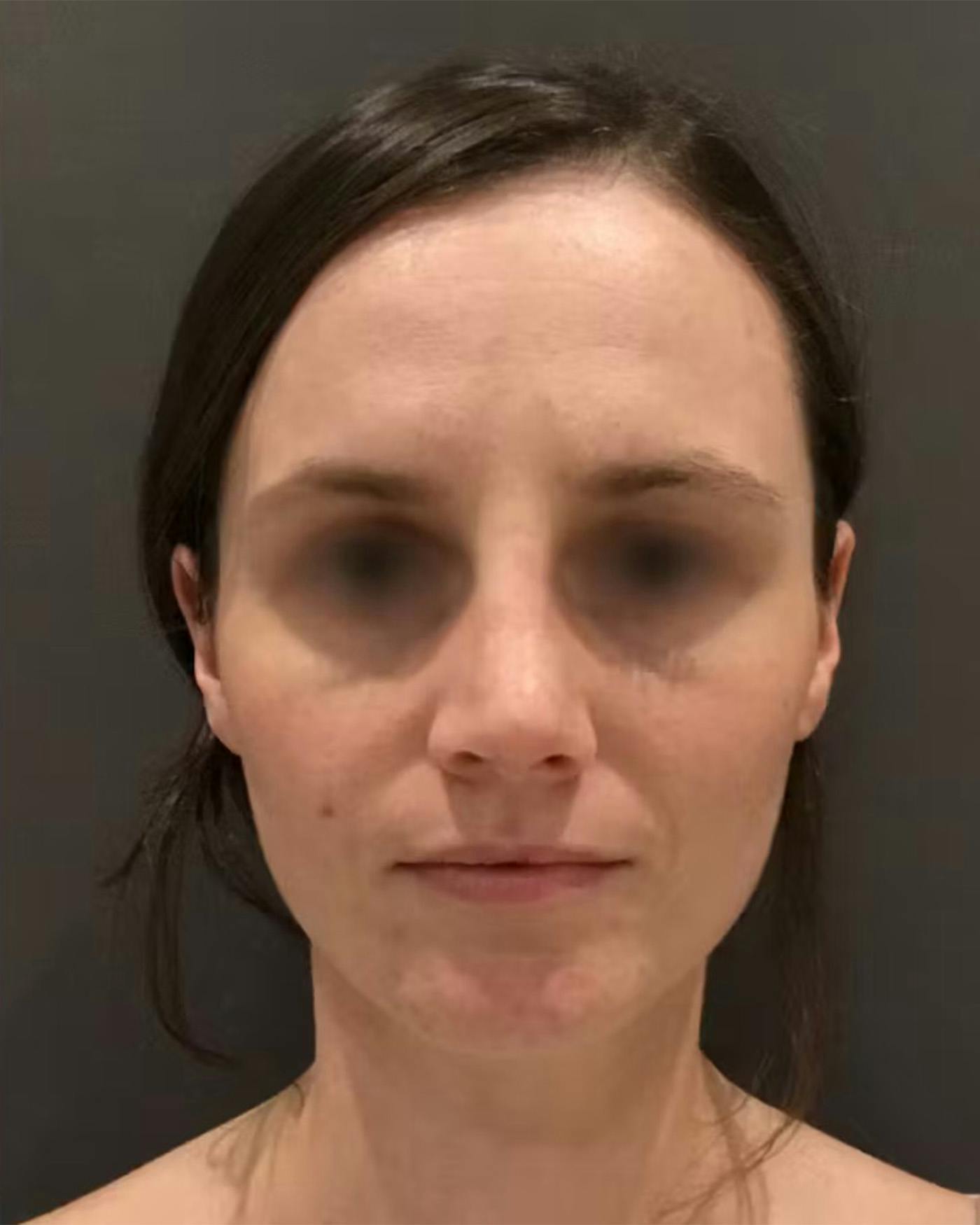 Rhinoplasty Before & After Gallery - Patient 172023 - Image 6