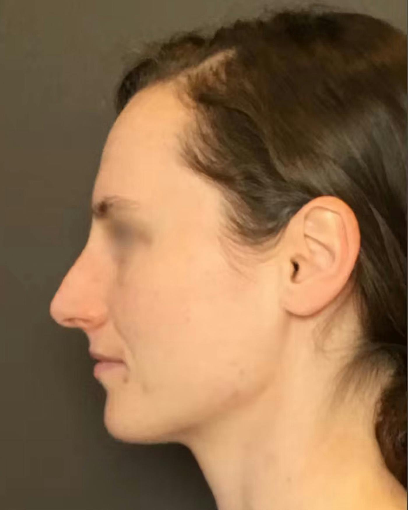 Rhinoplasty Before & After Gallery - Patient 172023 - Image 9