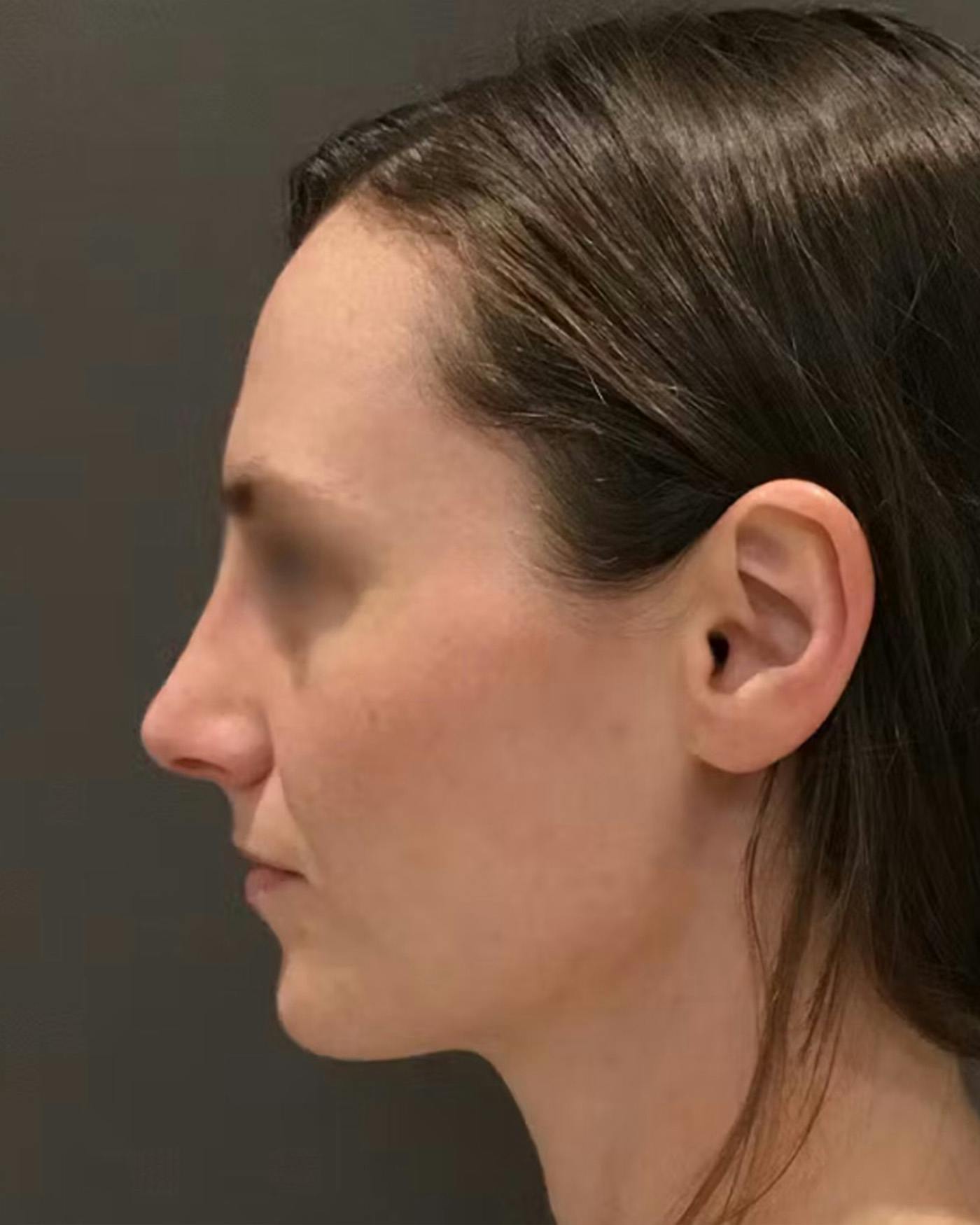 Rhinoplasty Before & After Gallery - Patient 172023 - Image 10