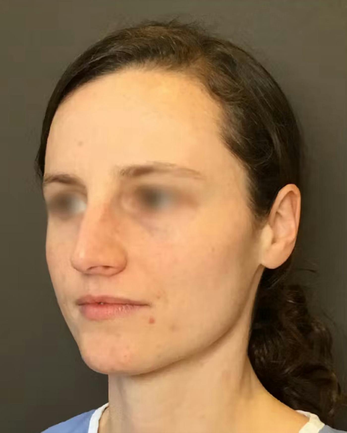 Rhinoplasty Before & After Gallery - Patient 172023 - Image 7